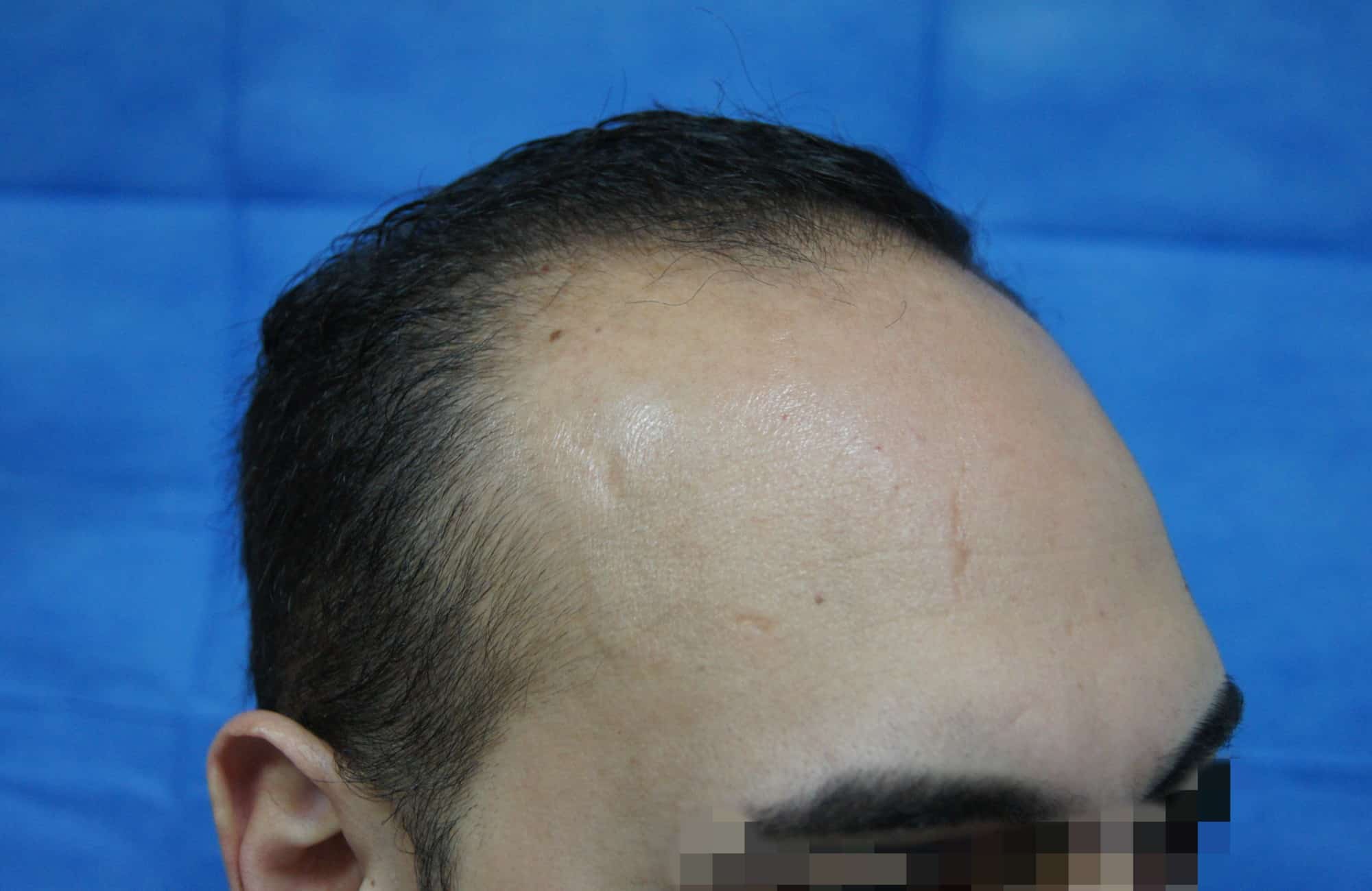 μεταμοσχευση μαλλιων πριν και μετα