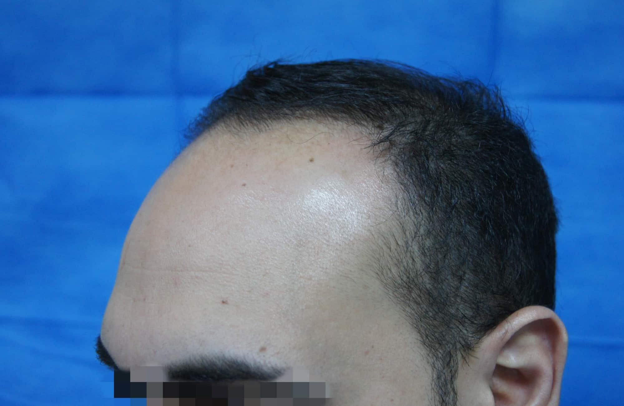μεταμοσχευση μαλλιων πριν και μετα