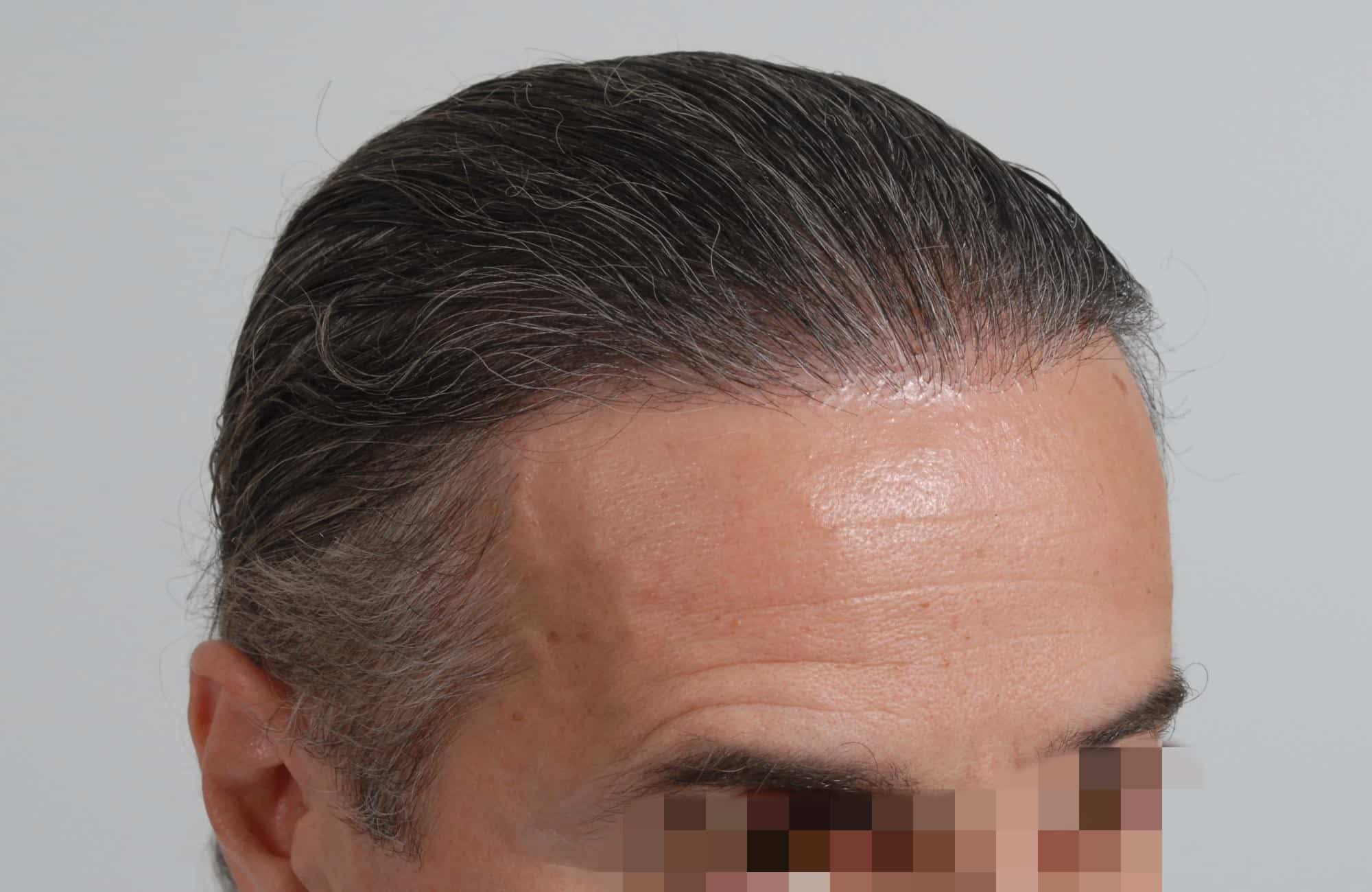 μεταμοσχευση μαλλιων πριν και μετα