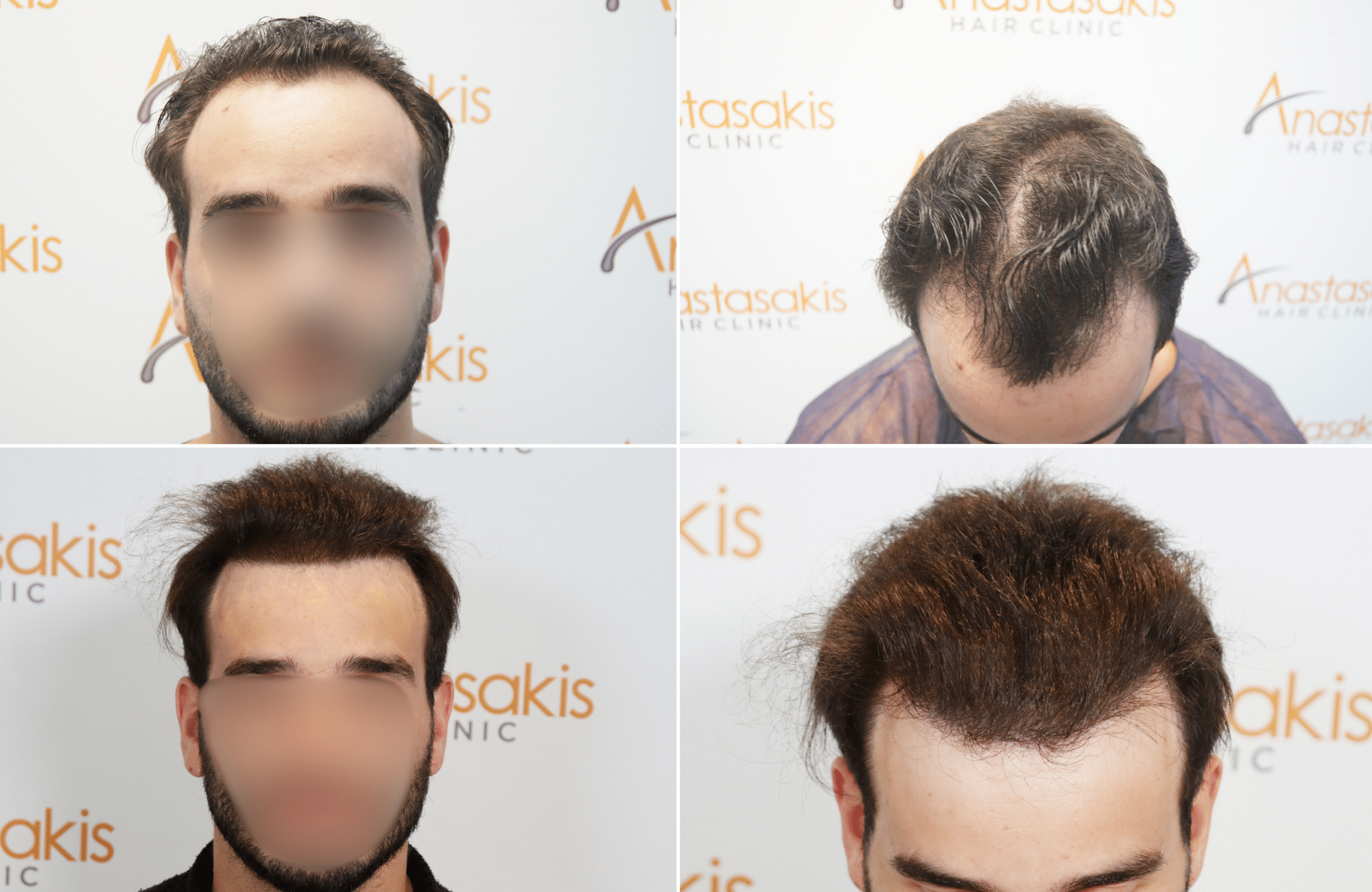 https://www.anastasakishairclinic.gr/portfolio/apotelesma-metamosxefsis-mallion-anastasakis-hair-clinic-88/