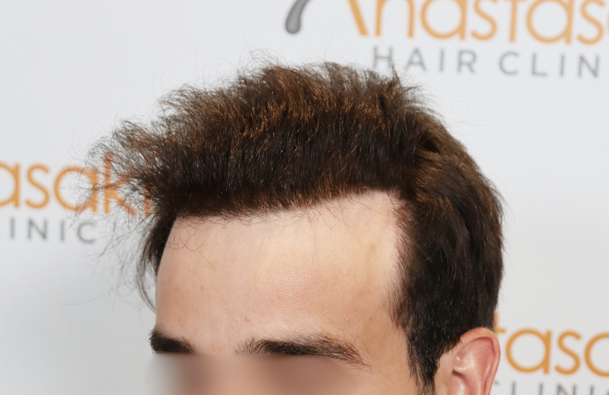 HAIR TRANSPLANT RESULT 2400 FUS(10)