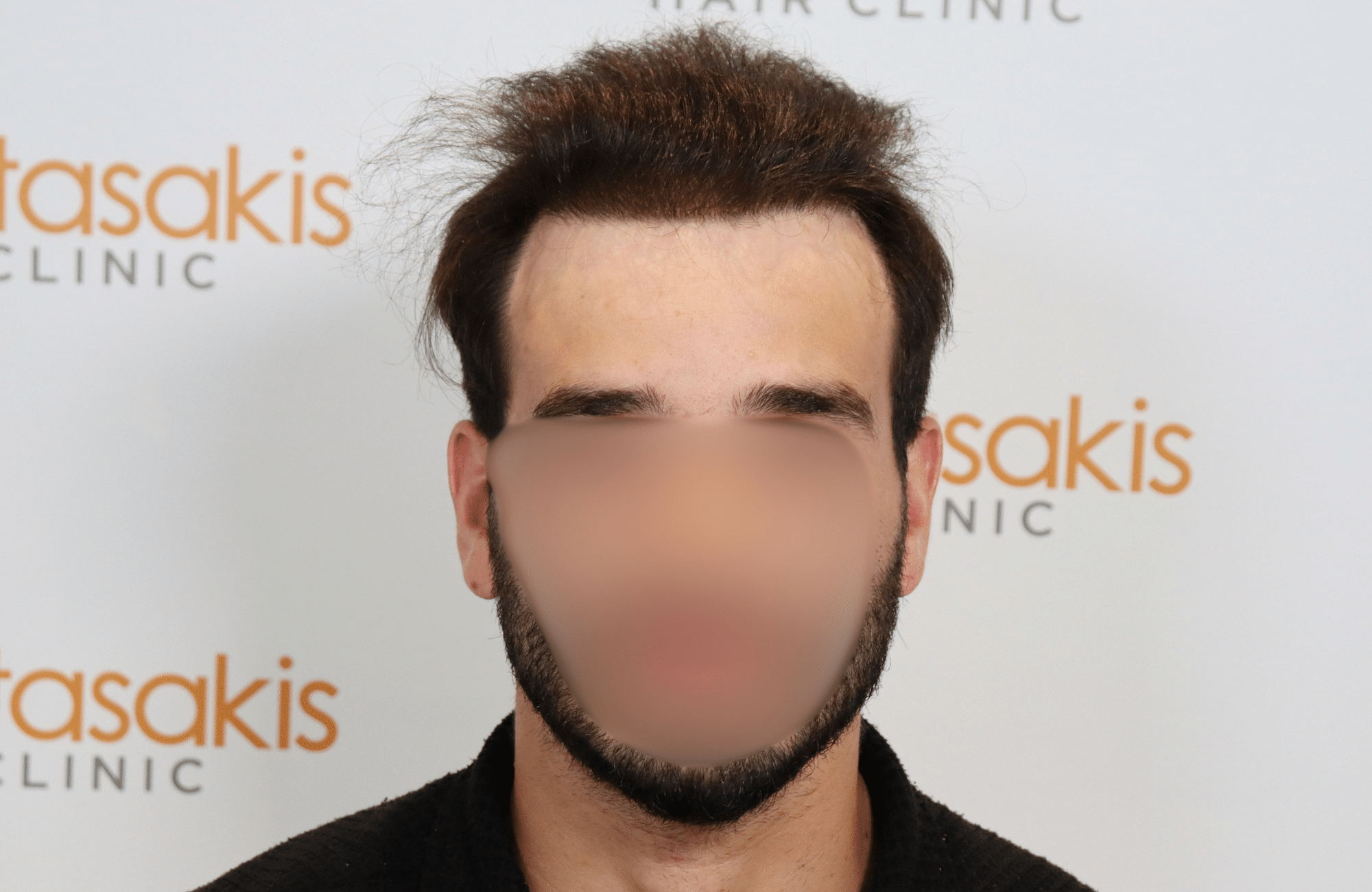 HAIR TRANSPLANT RESULT 2400 FUS(4)