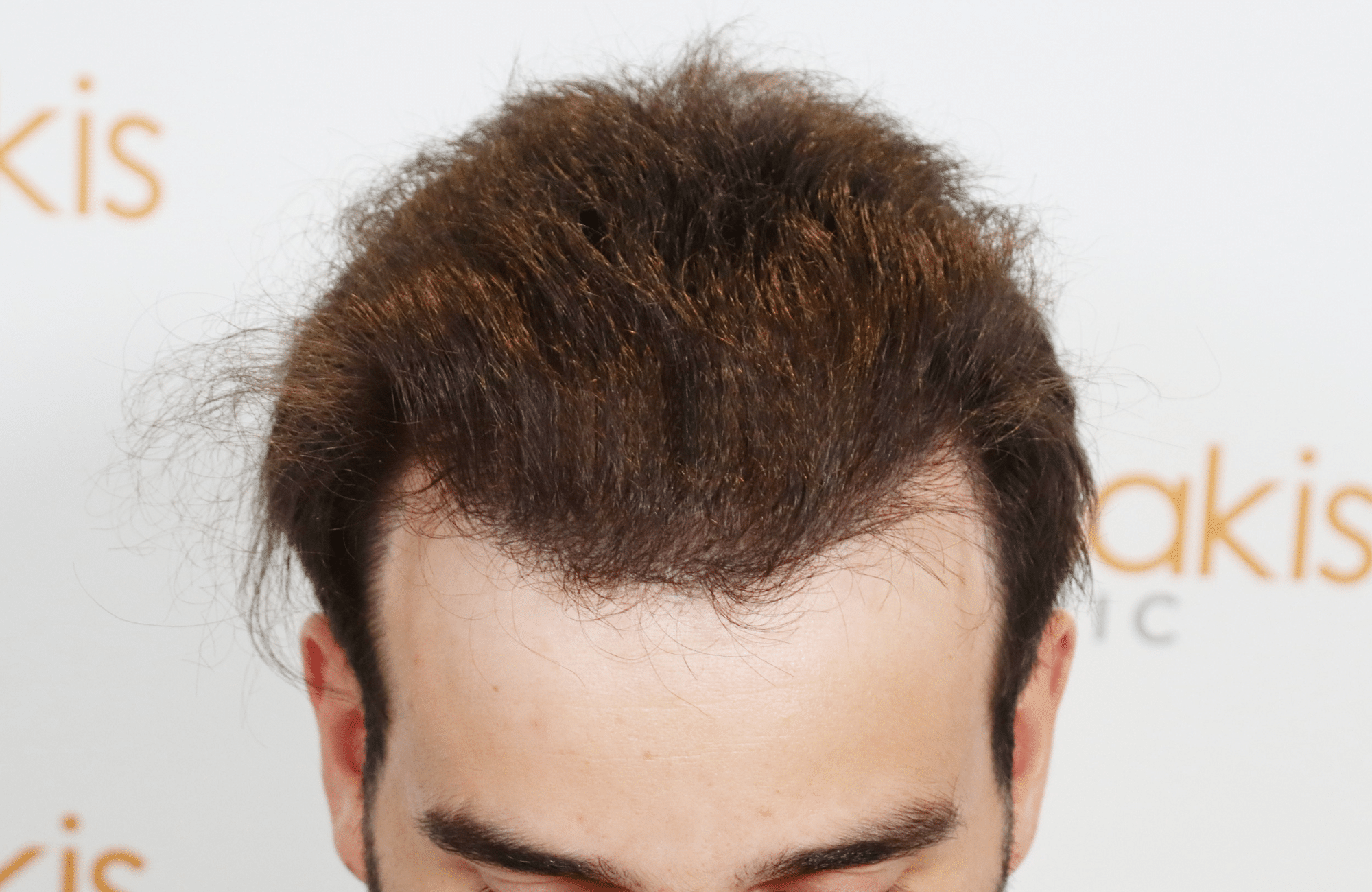 HAIR TRANSPLANT RESULT 2400 FUS(5)