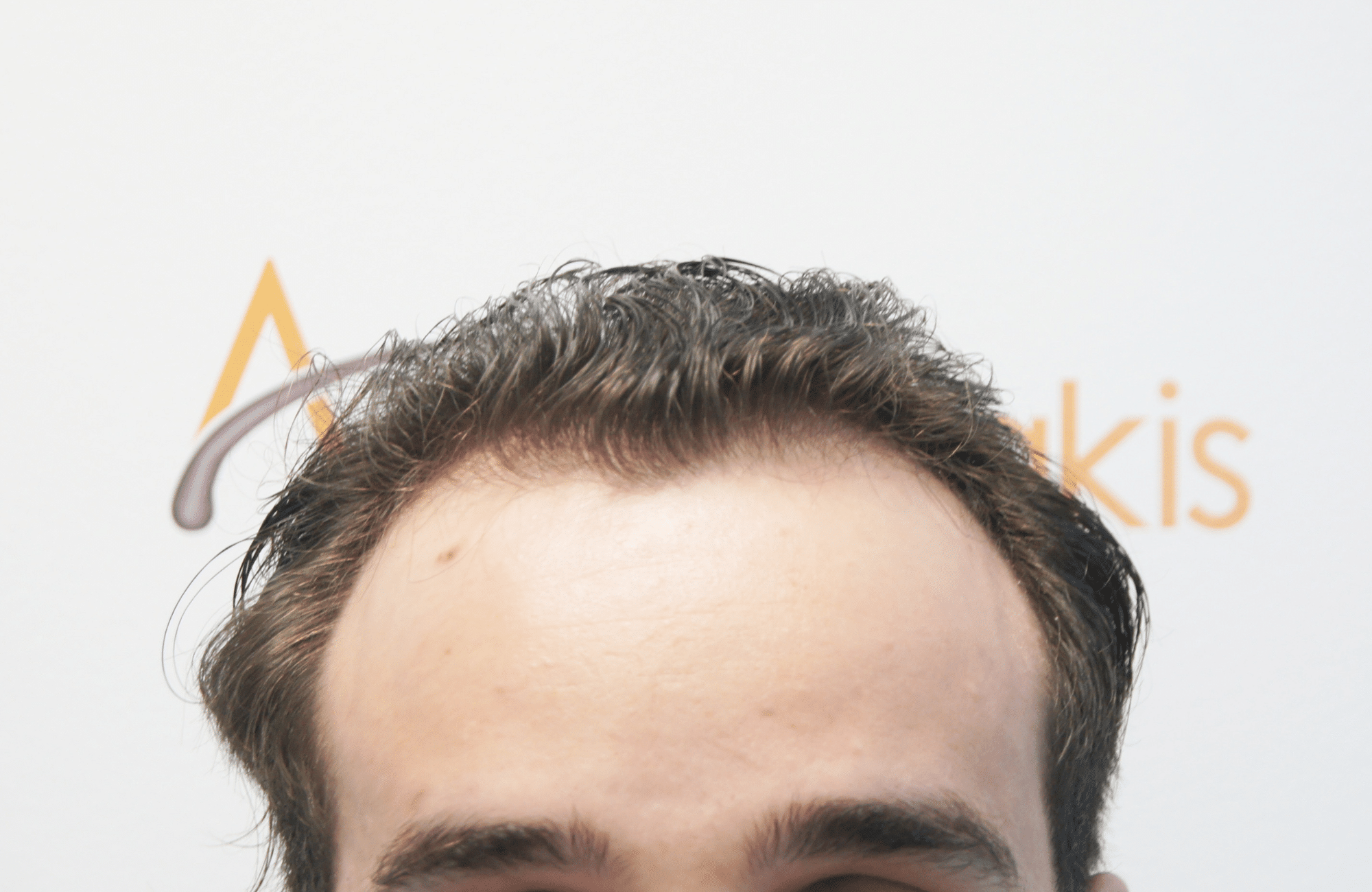 HAIR TRANSPLANT RESULT 2400 FUS(6)