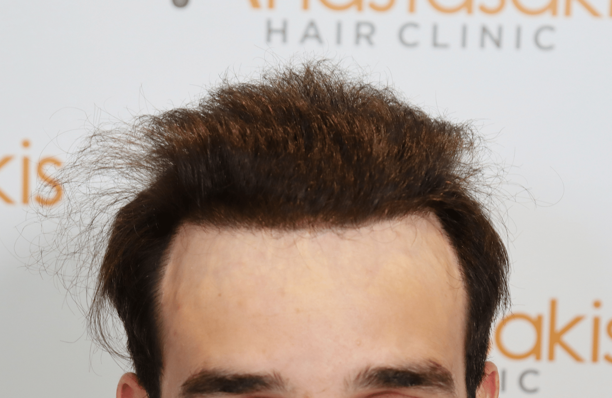 HAIR TRANSPLANT RESULT 2400 FUS(6)