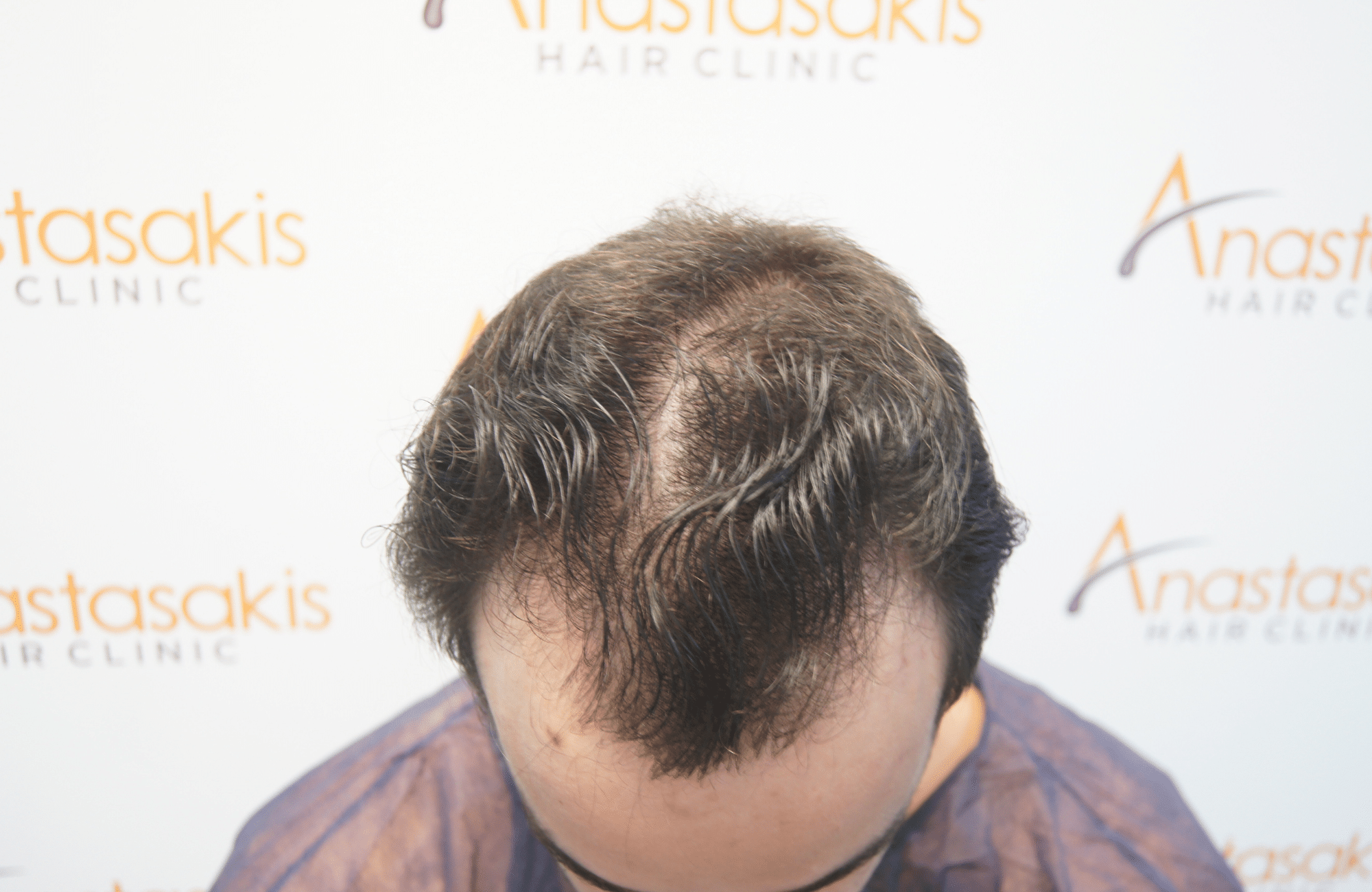 HAIR TRANSPLANT RESULT 2400 FUS(8)