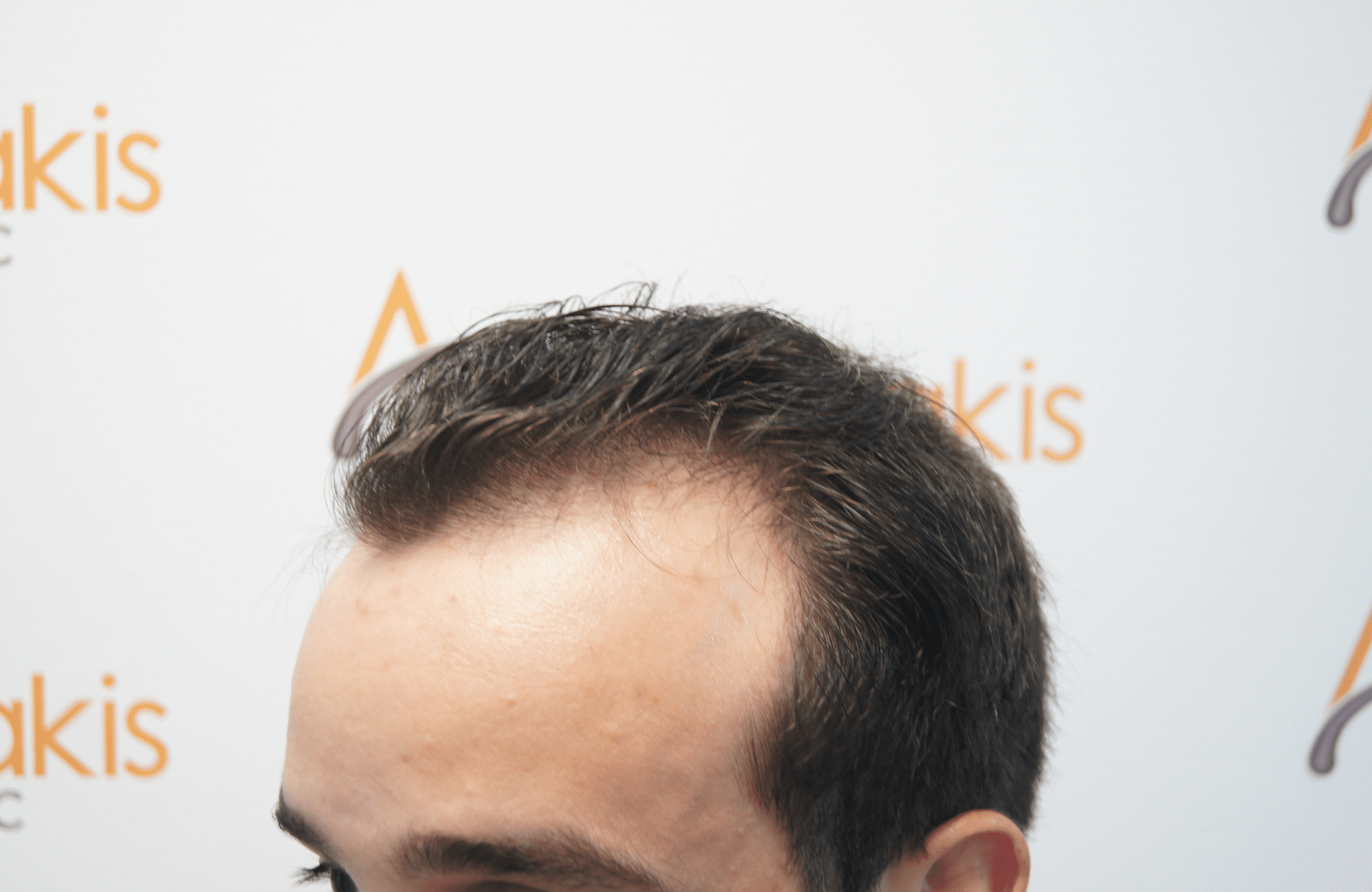 HAIR TRANSPLANT RESULT 2400 FUS(9)