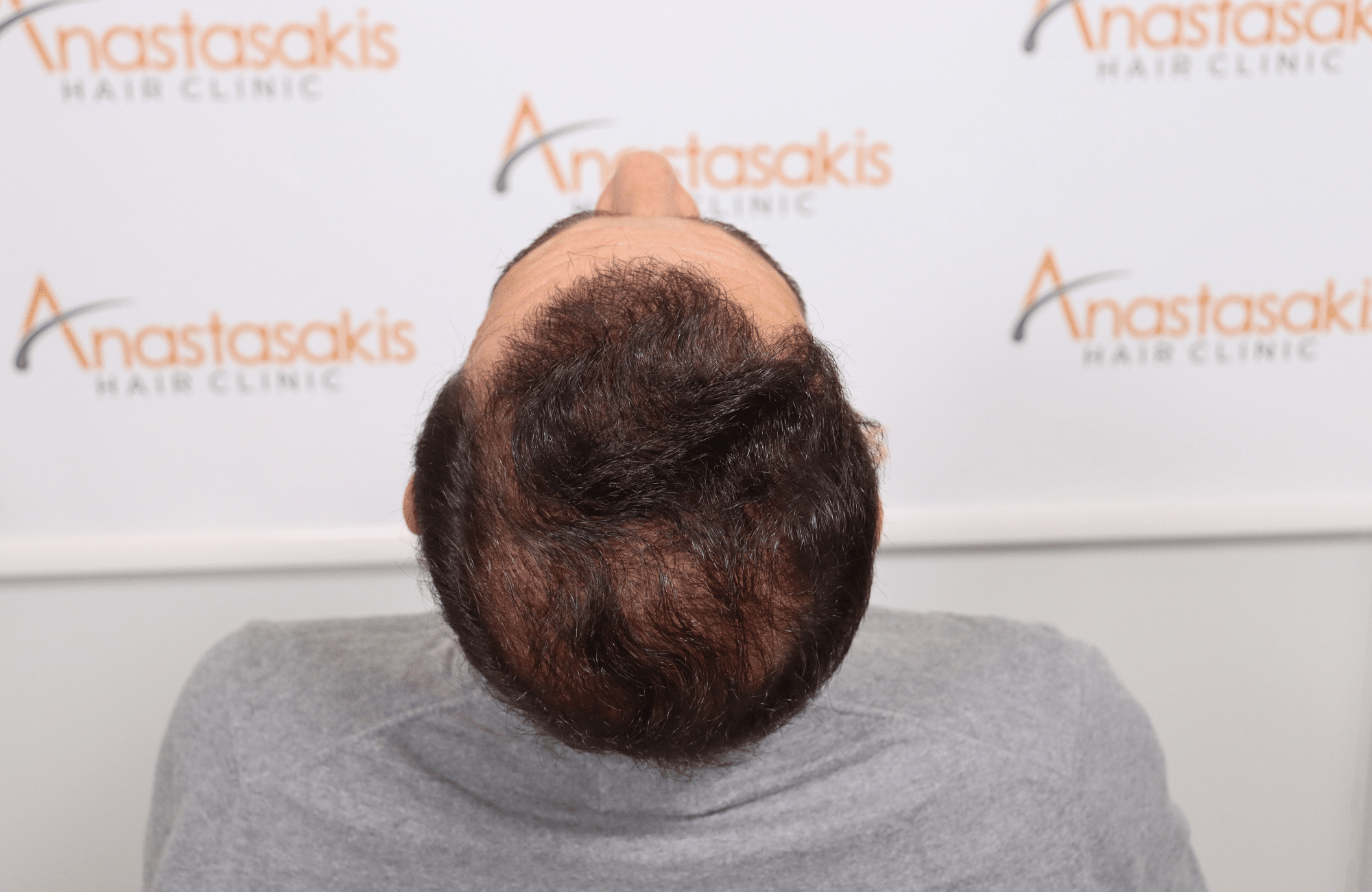 HAIR TRANSPLANT RESULT 2500 FUS (10)
