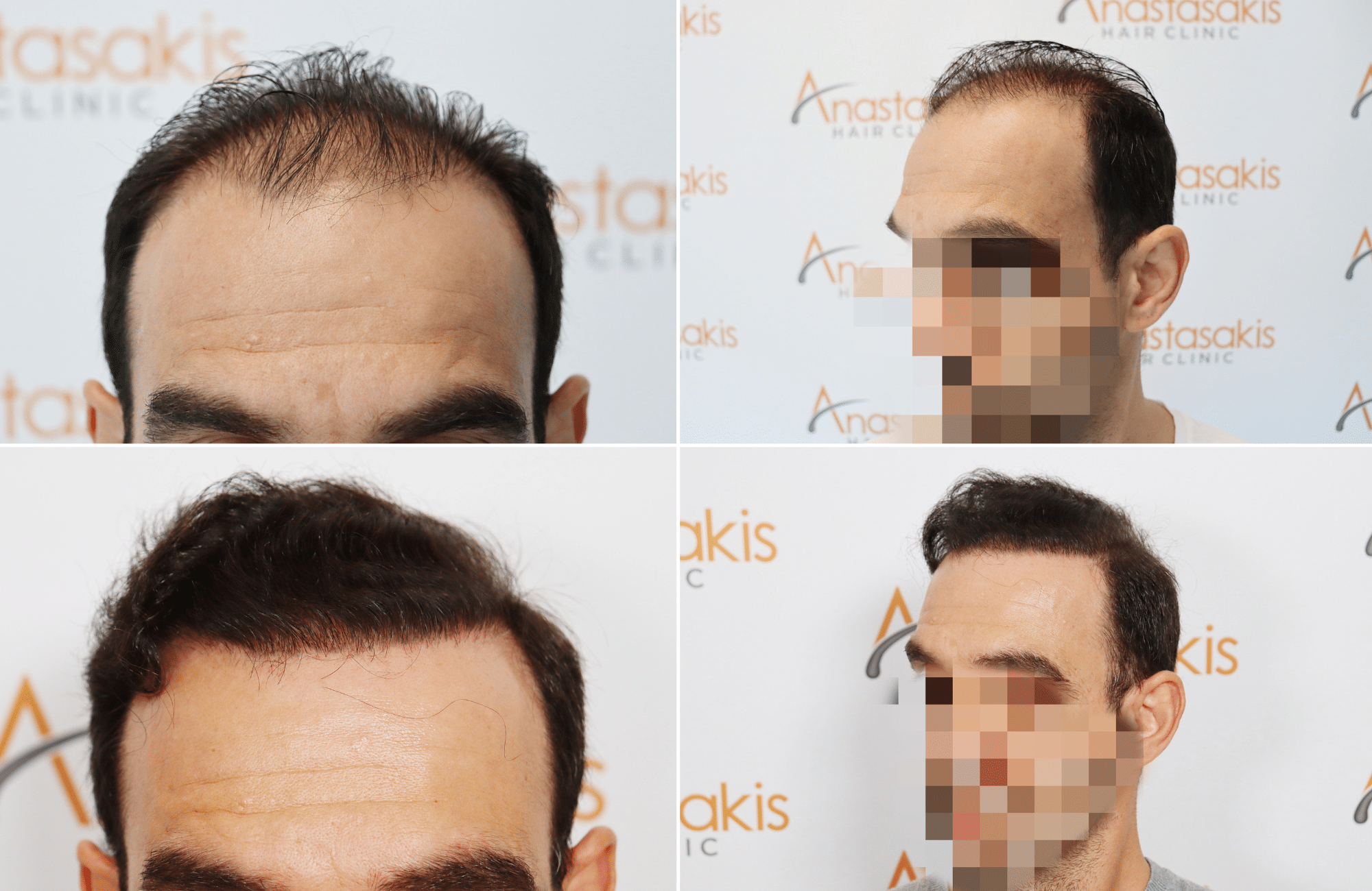 https://www.anastasakishairclinic.gr/portfolio/apotelesma-metamosxefsis-mallion-anastasakis-hair-clinic-95/