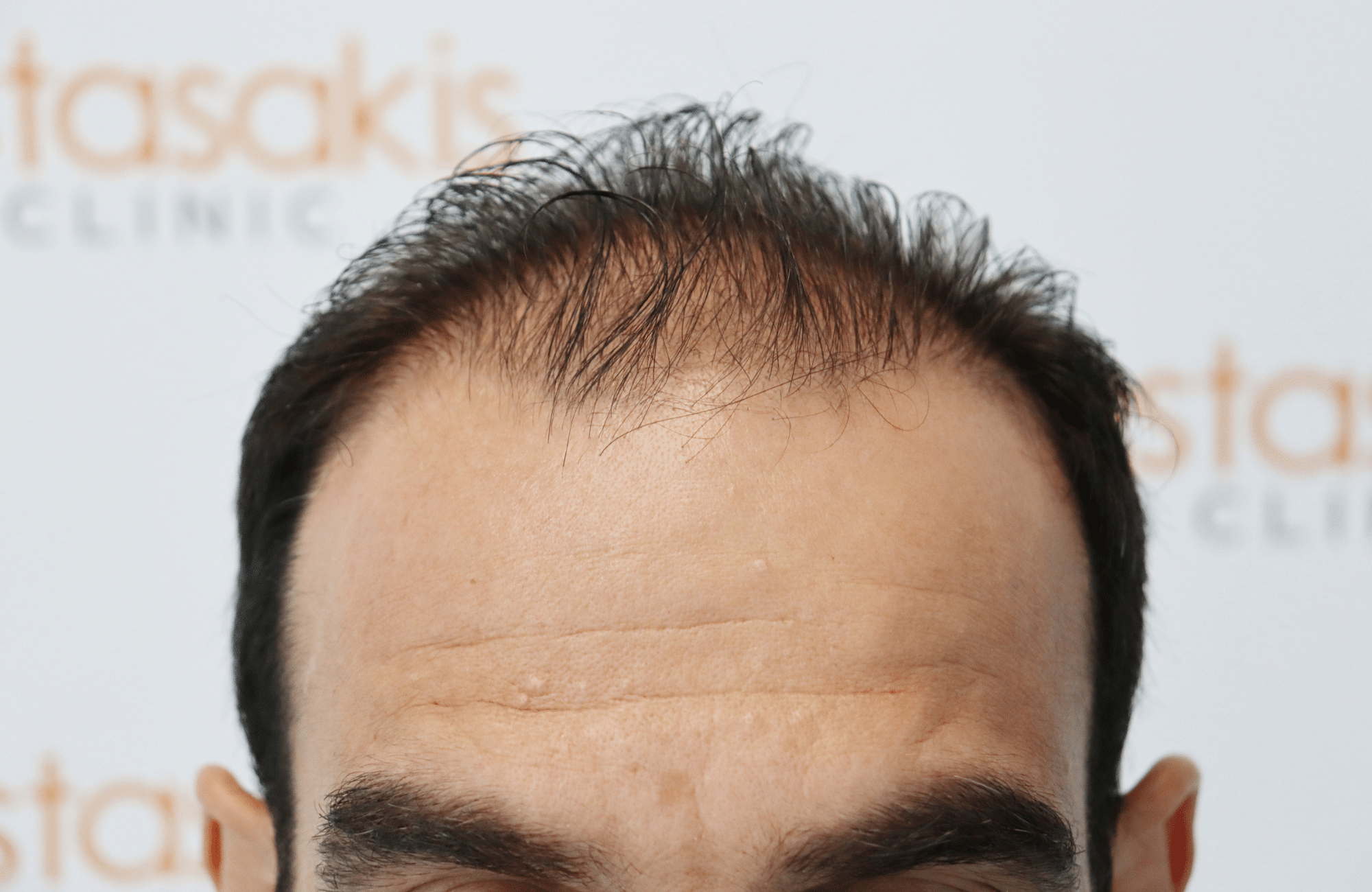 HAIR TRANSPLANT RESULT 2500 FUS (3)