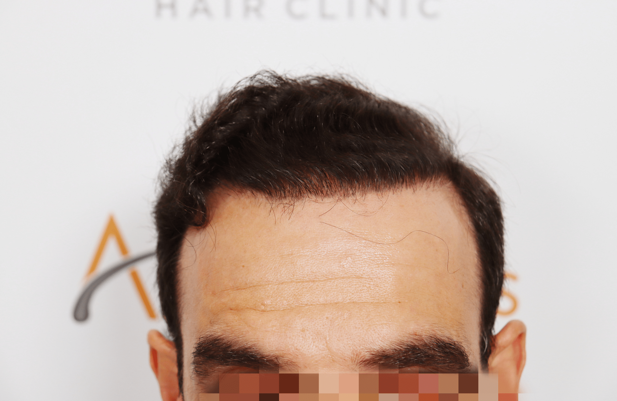 HAIR TRANSPLANT RESULT 2500 FUS (4)