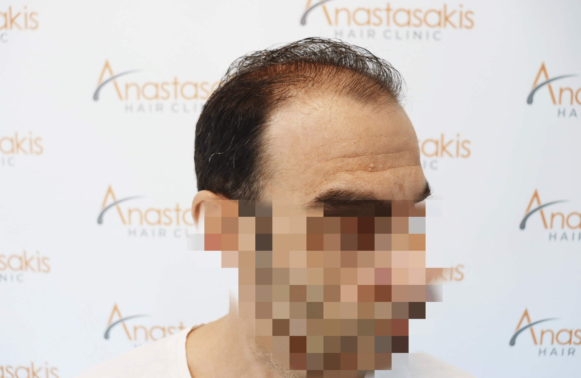 HAIR TRANSPLANT RESULT 2500 FUS (5)