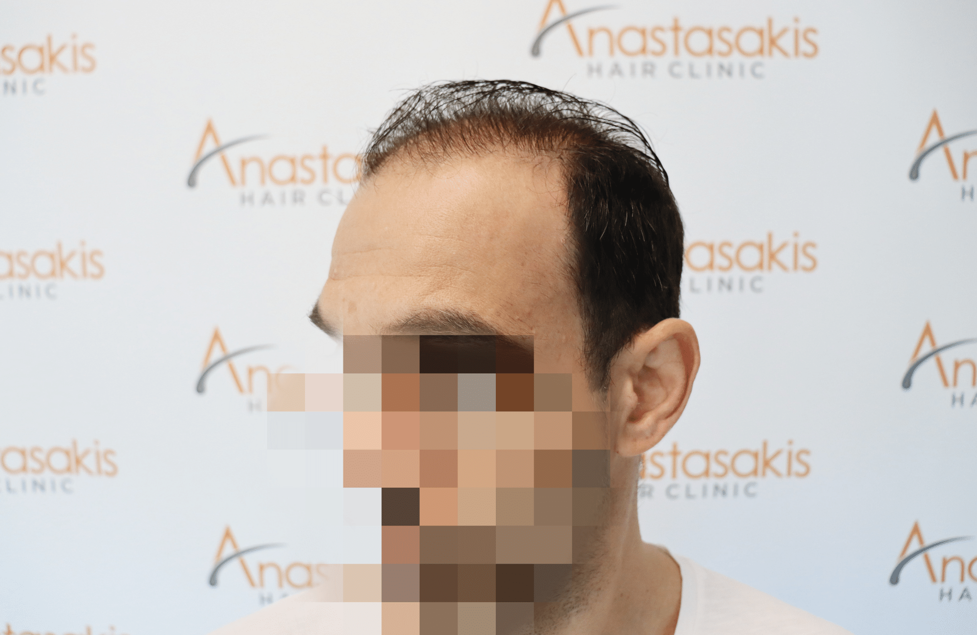 HAIR TRANSPLANT RESULT 2500 FUS (6)