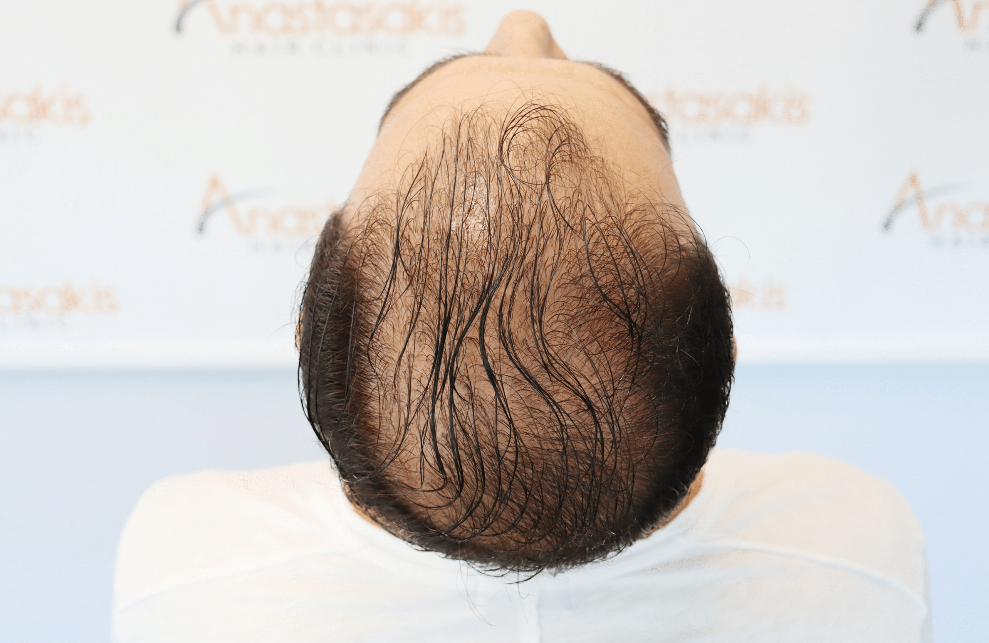 HAIR TRANSPLANT RESULT 2500 FUS (7)