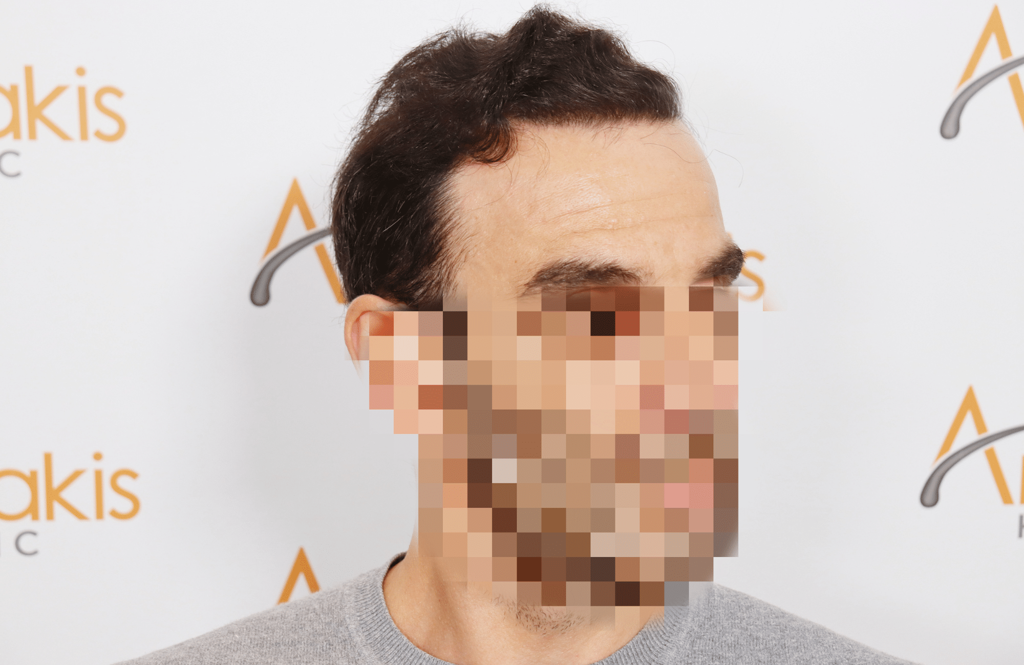 HAIR TRANSPLANT RESULT 2500 FUS (8)