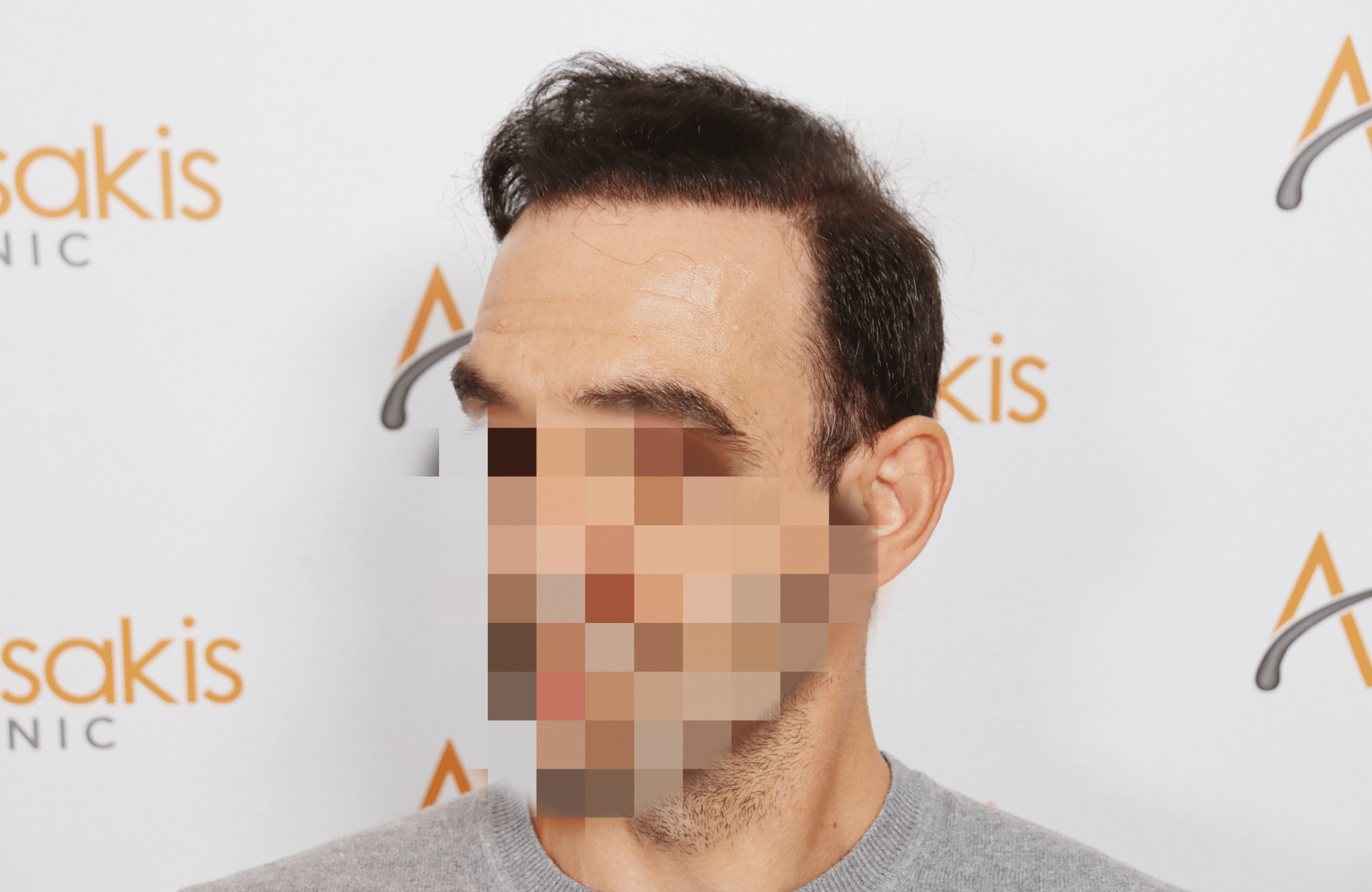 HAIR TRANSPLANT RESULT 2500 FUS (9)