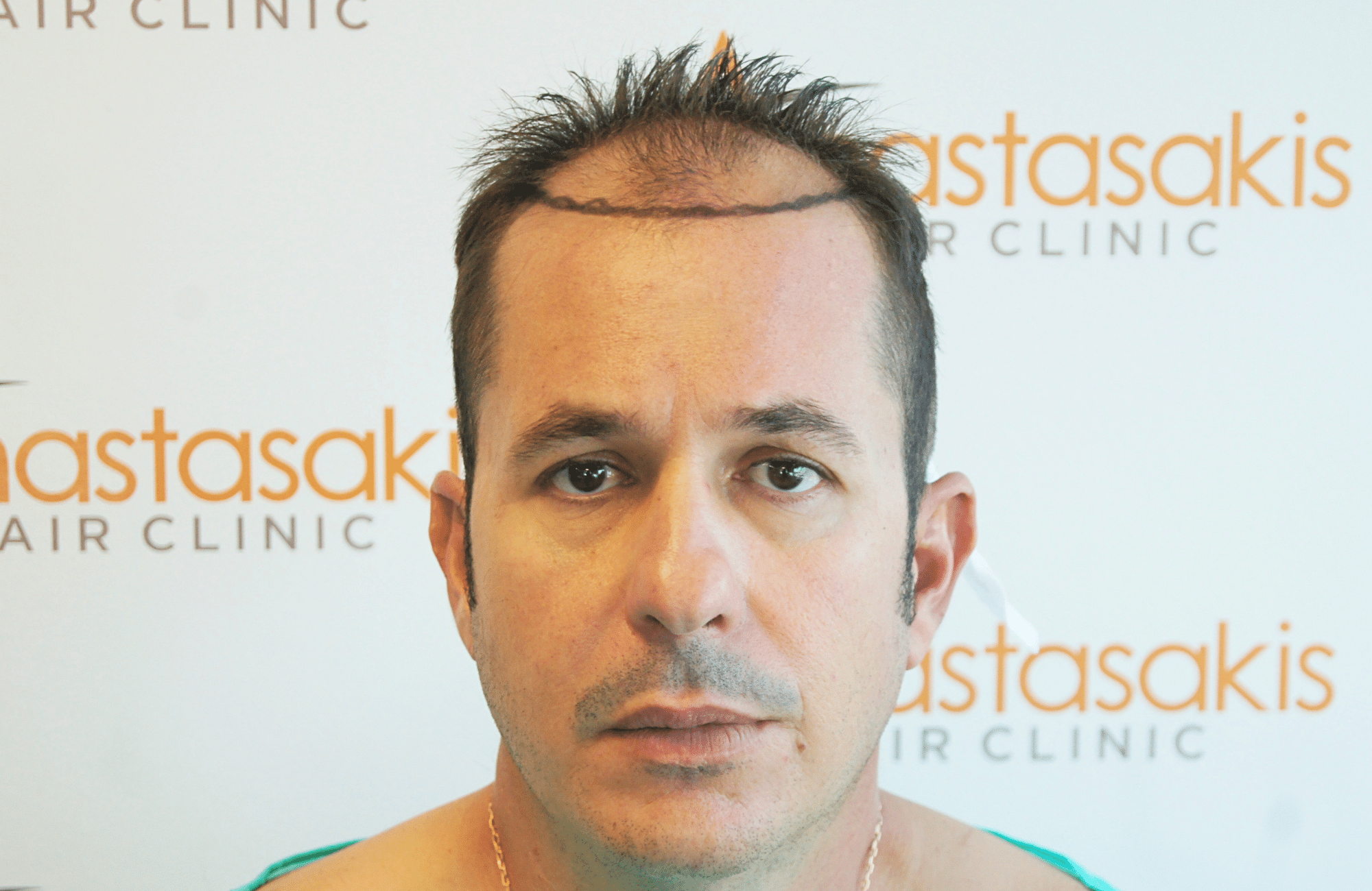 HAIR TRANSPLANT RESULT 2600 FUS STAGE 4 (1)