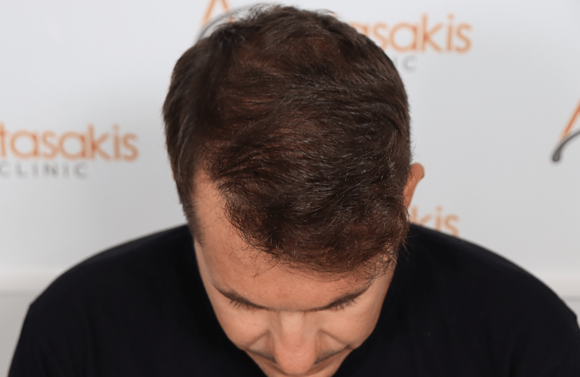 HAIR TRANSPLANT RESULT 2600 FUS STAGE 4 (10)