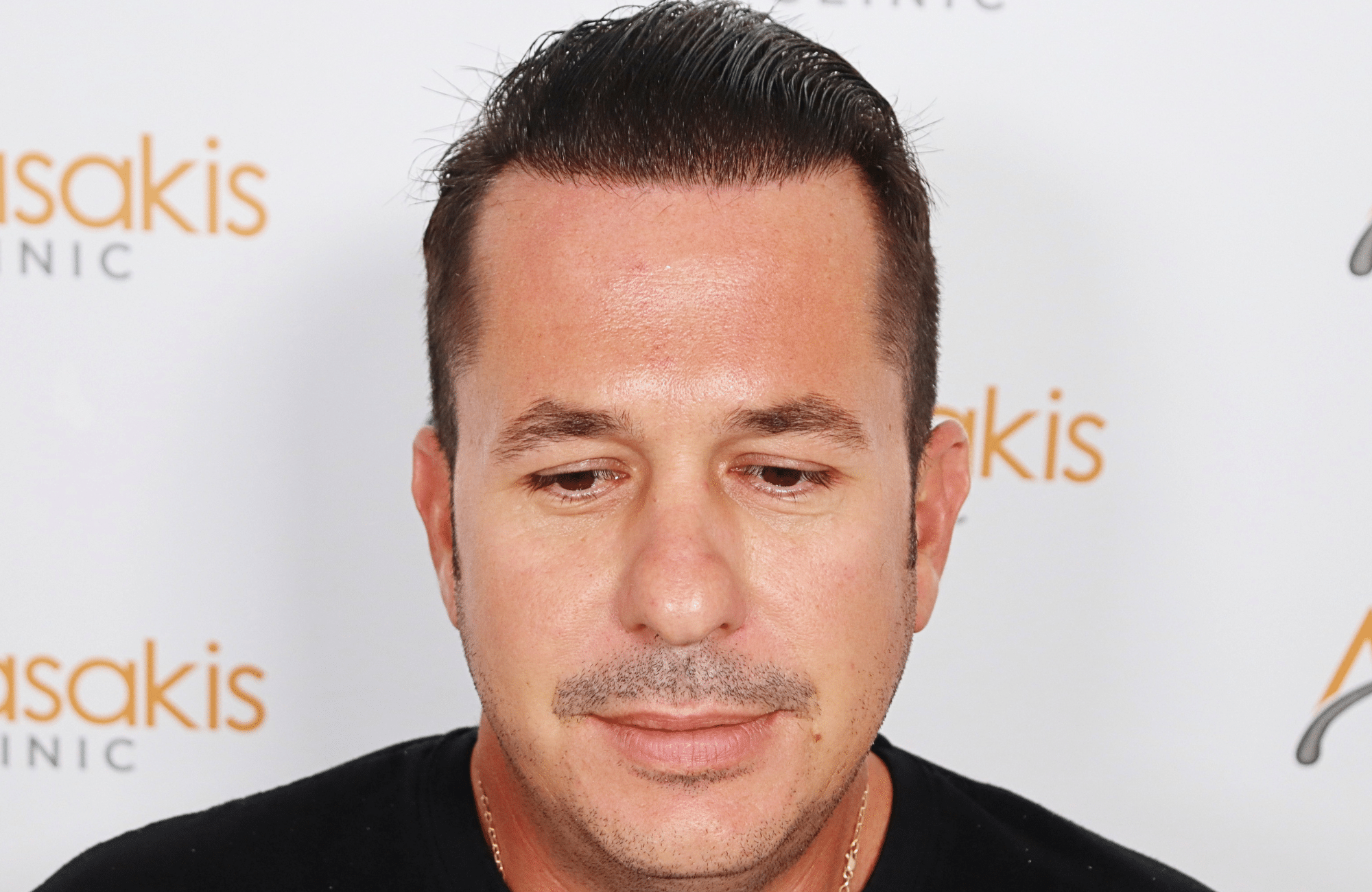 HAIR TRANSPLANT RESULT 2600 FUS STAGE 4 (11)