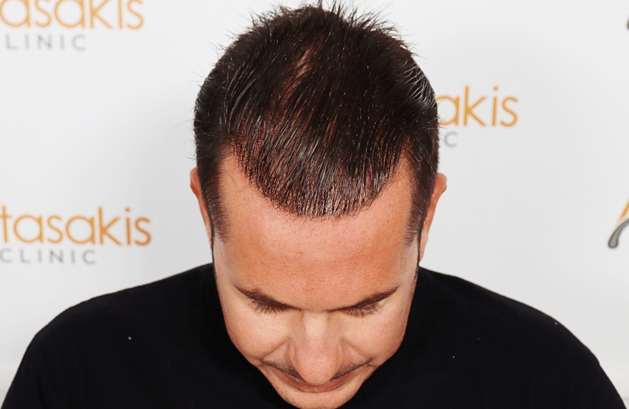 HAIR TRANSPLANT RESULT 2600 FUS STAGE 4 (12)