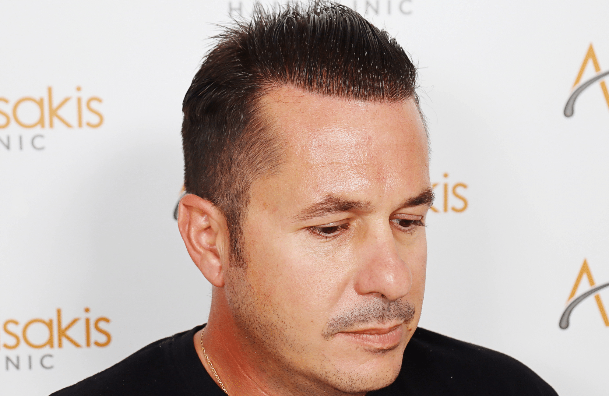 HAIR TRANSPLANT RESULT 2600 FUS STAGE 4 (14)