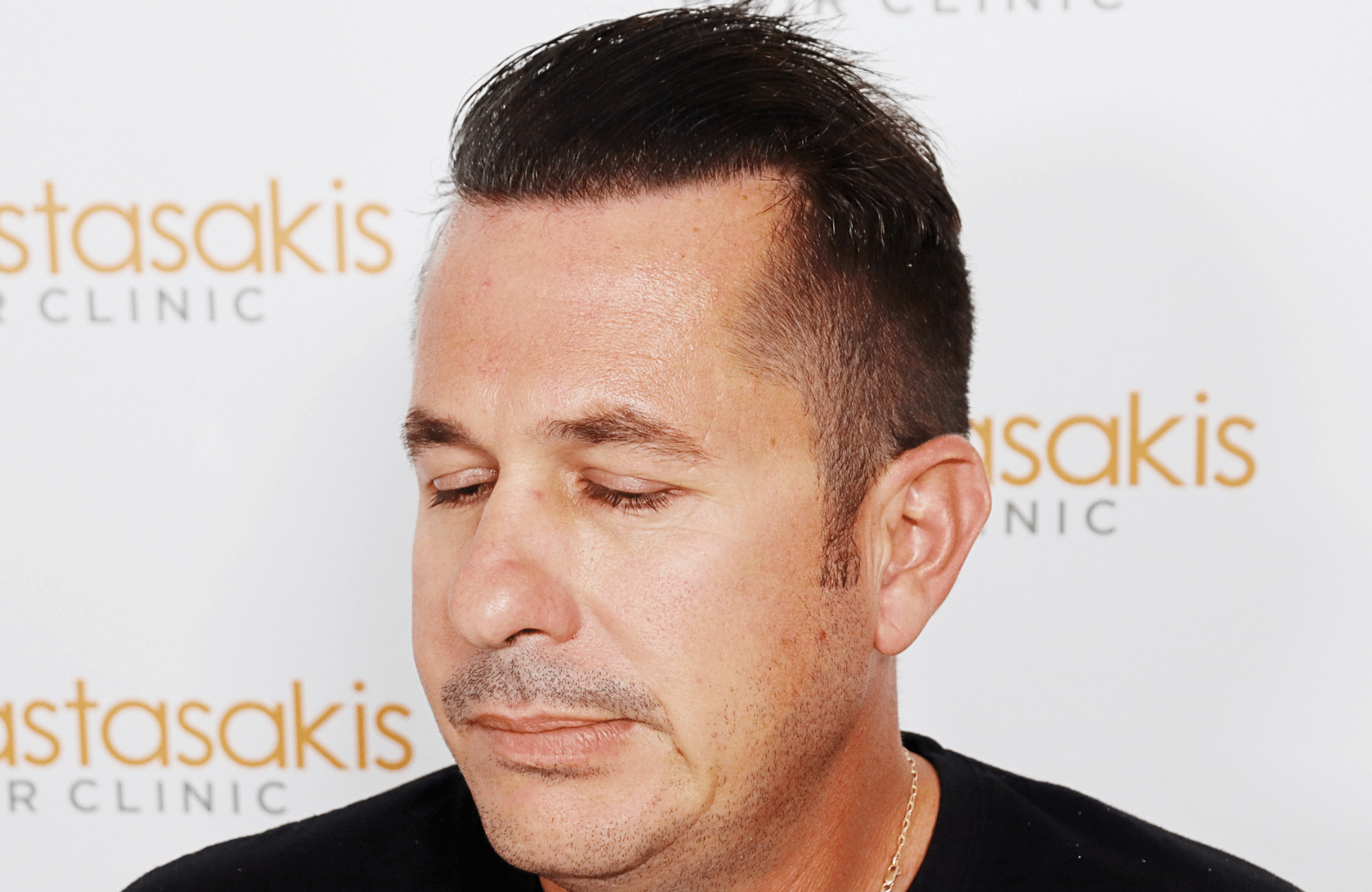 HAIR TRANSPLANT RESULT 2600 FUS STAGE 4 (14)