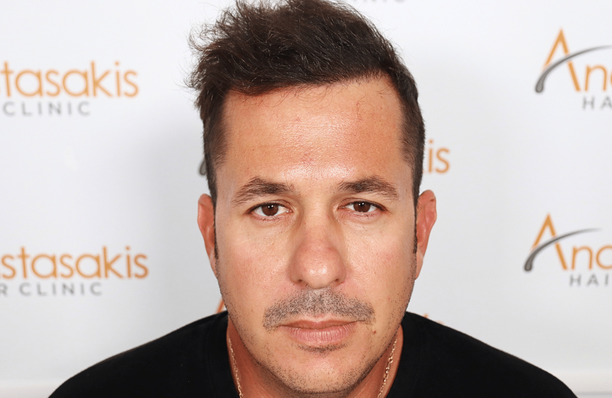 HAIR TRANSPLANT RESULT 2600 FUS STAGE 4 (2)