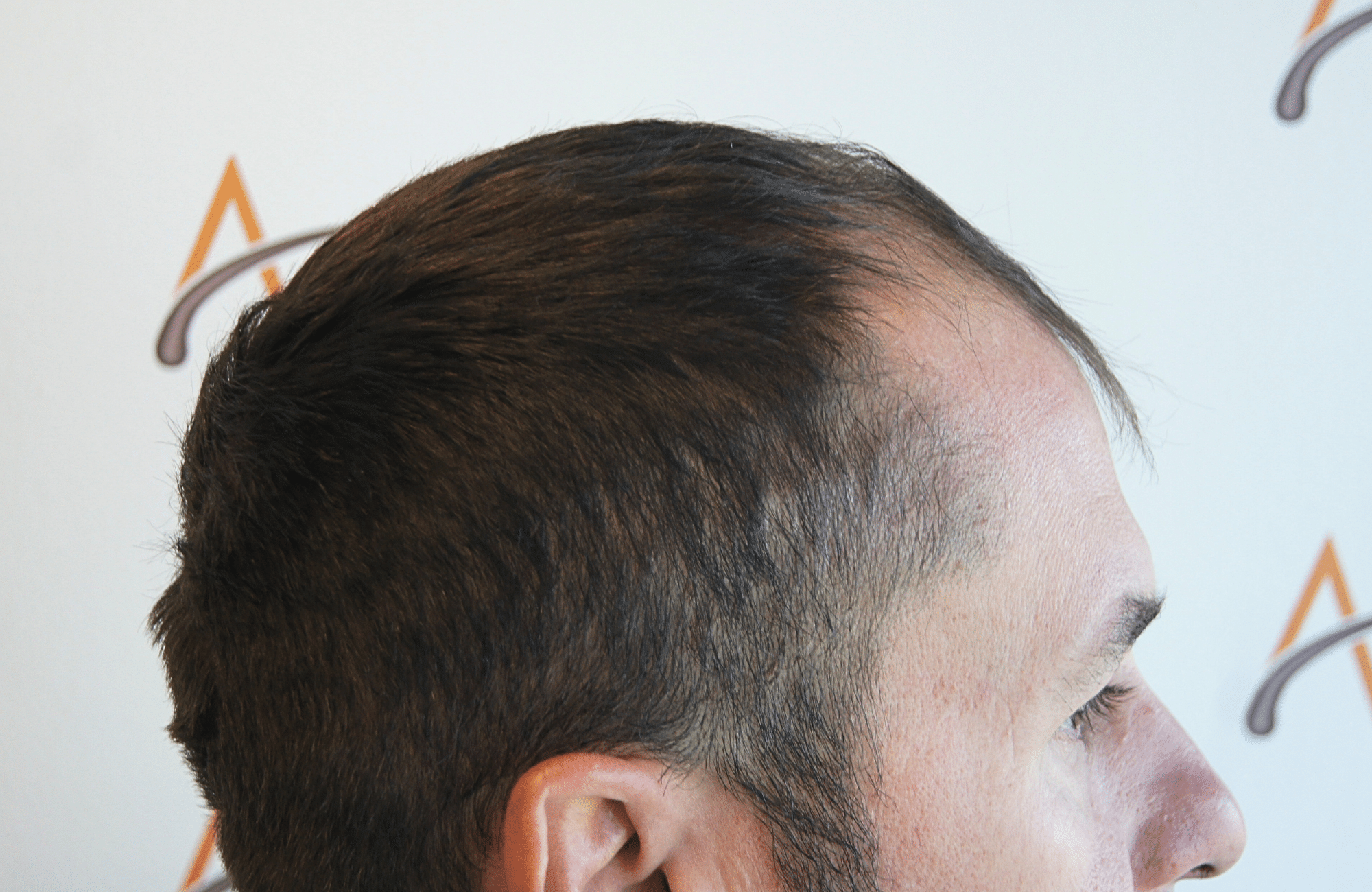 HAIR TRANSPLANT RESULT 2600 FUS STAGE 4 (3)
