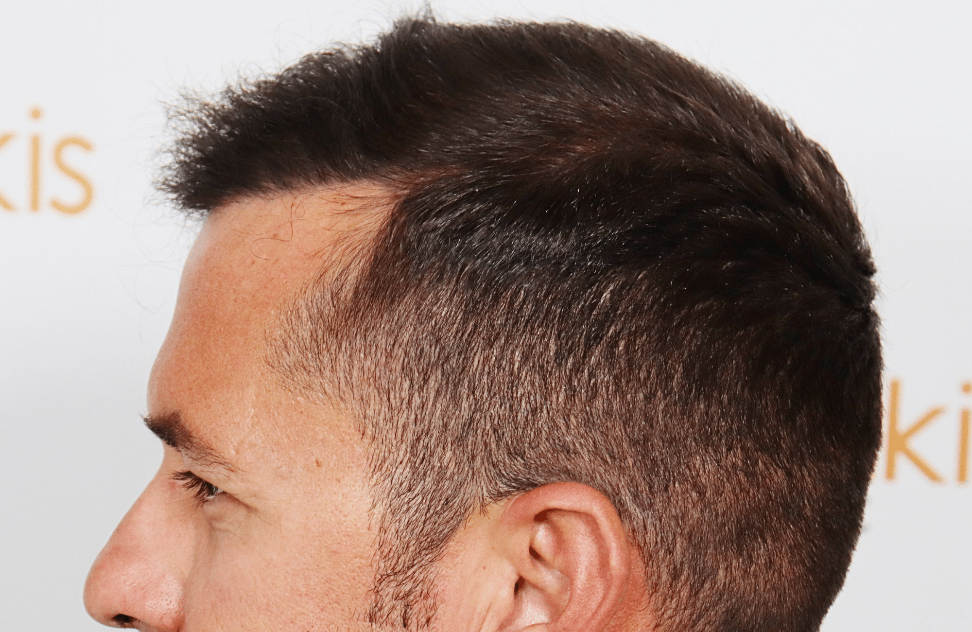 HAIR TRANSPLANT RESULT 2600 FUS STAGE 4 (6)