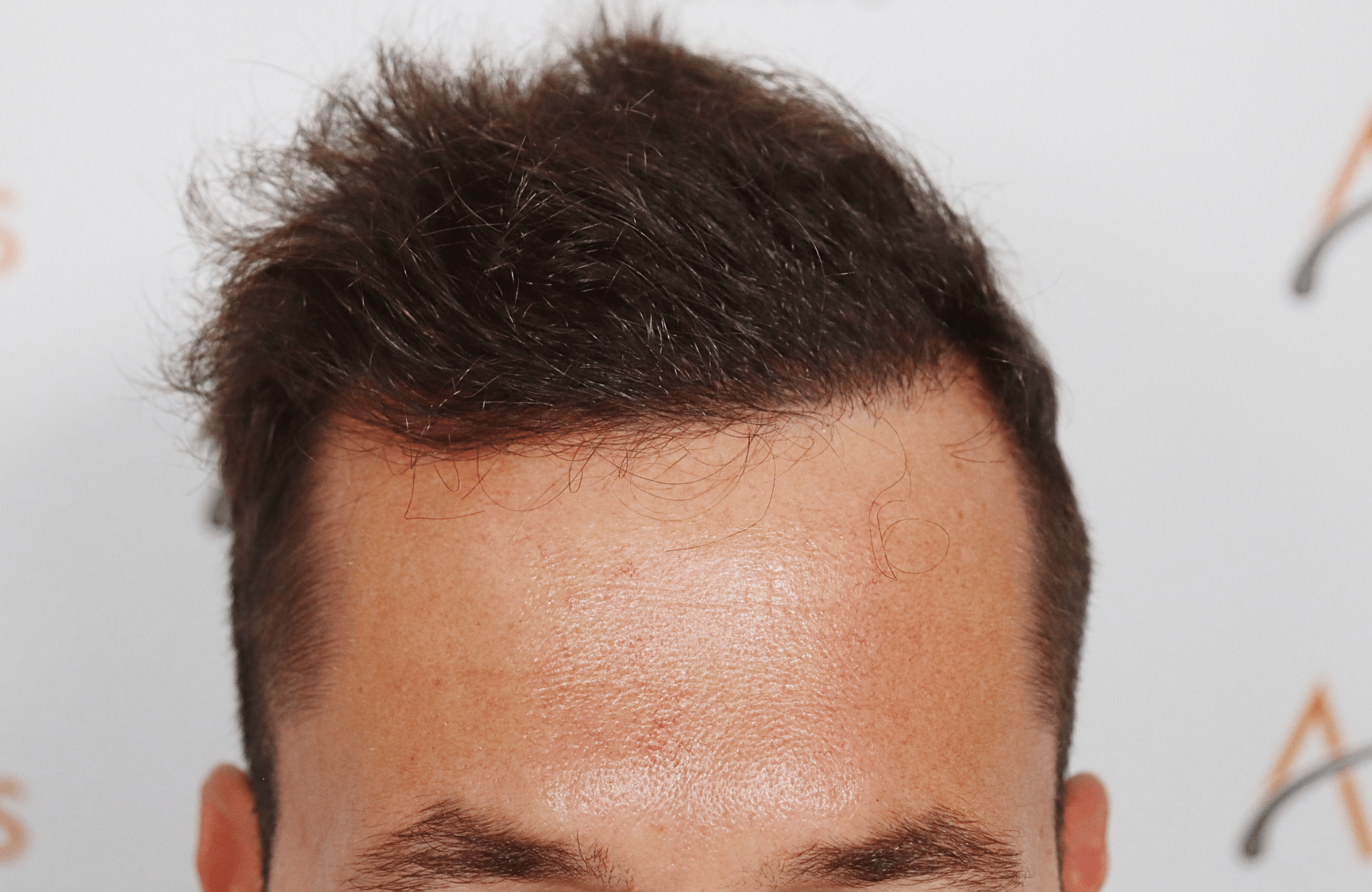 HAIR TRANSPLANT RESULT 2600 FUS STAGE 4 (8)