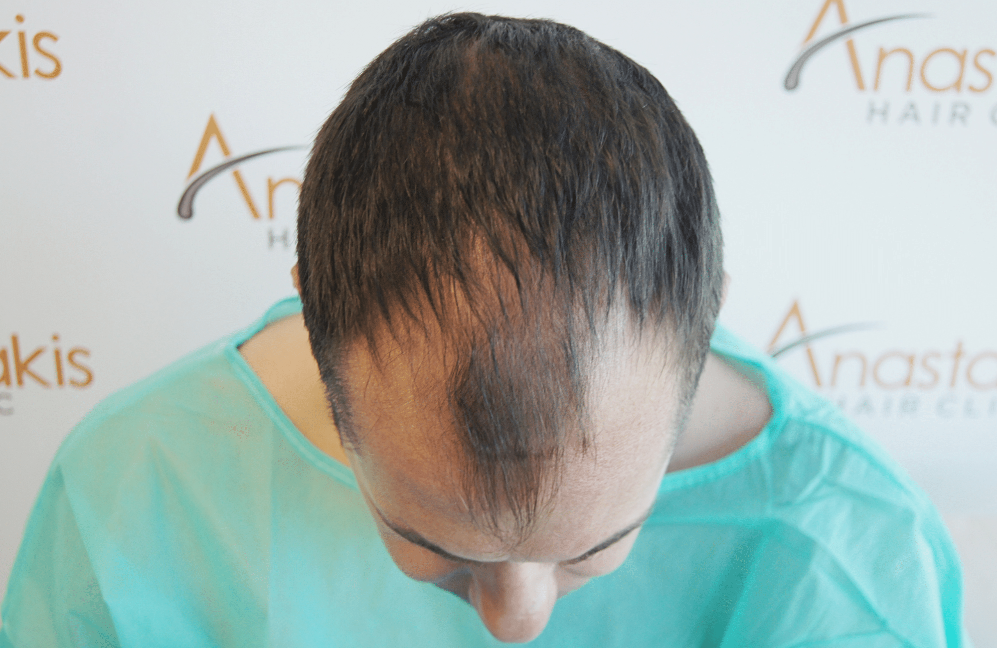 HAIR TRANSPLANT RESULT 2600 FUS STAGE 4 (9)