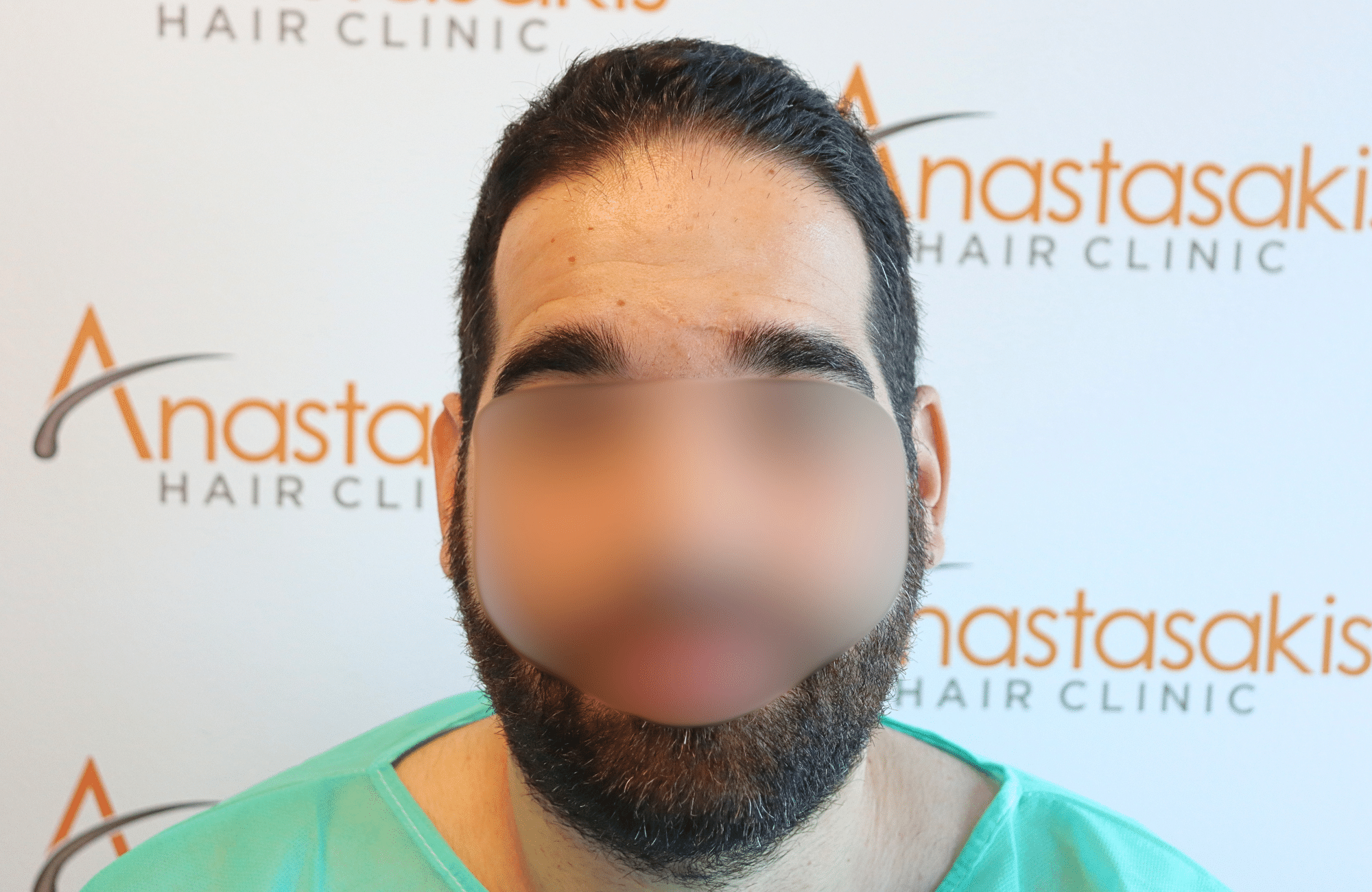 Hair Transplant Result 2300 fus frontal thick (1)