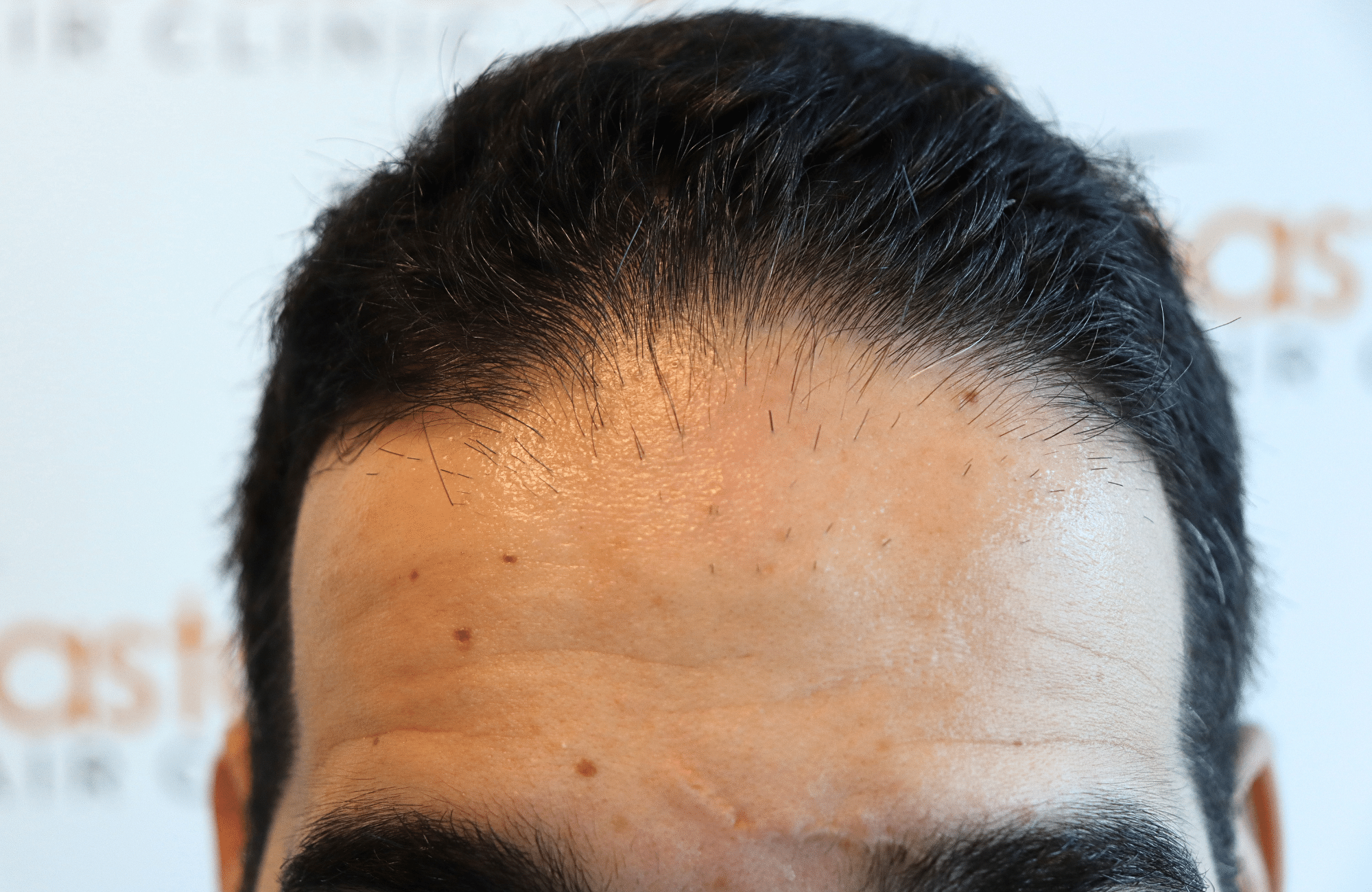 Hair Transplant Result 2300 fus frontal thick (11)