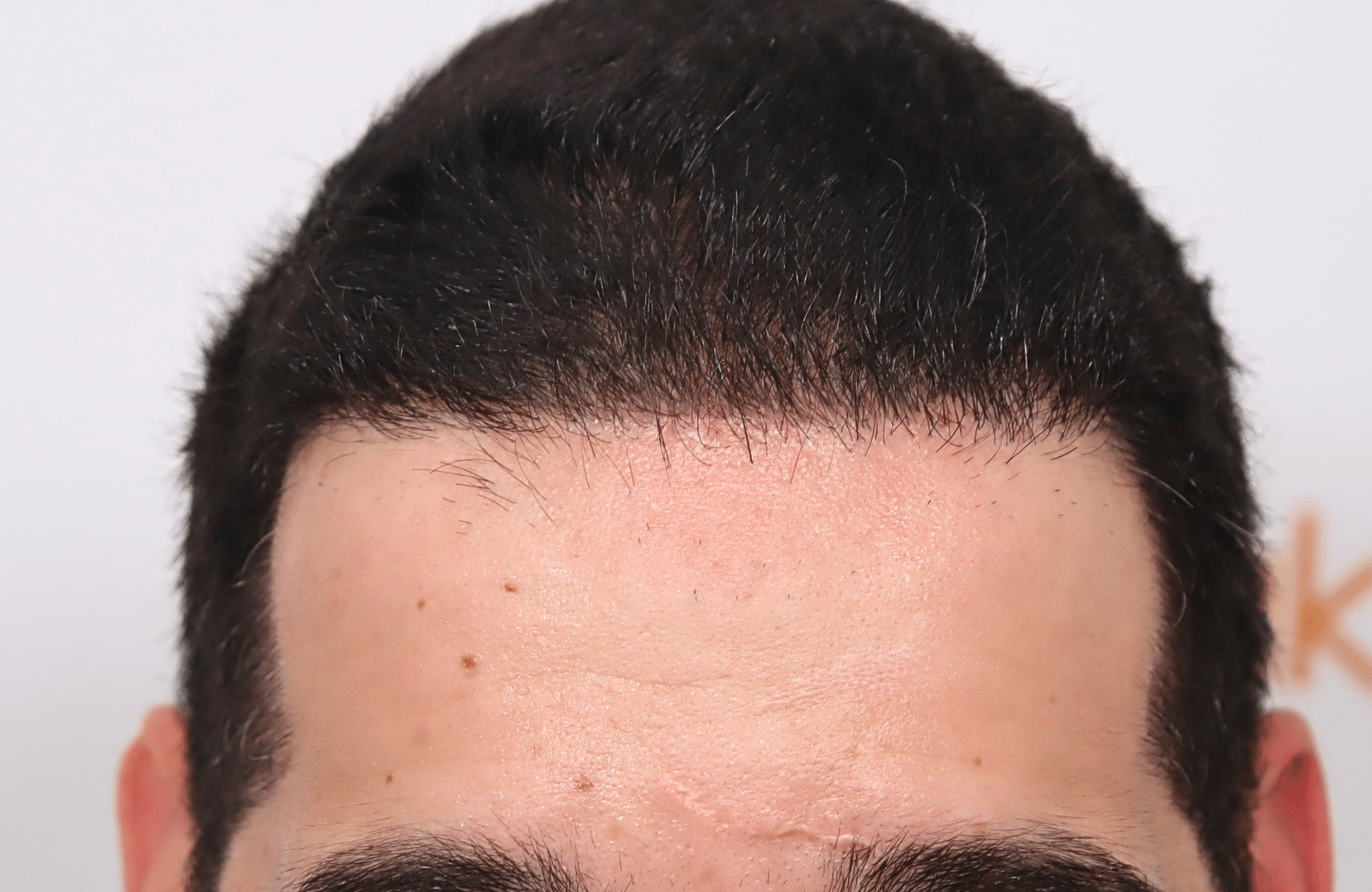 Hair Transplant Result 2300 fus frontal thick (12)