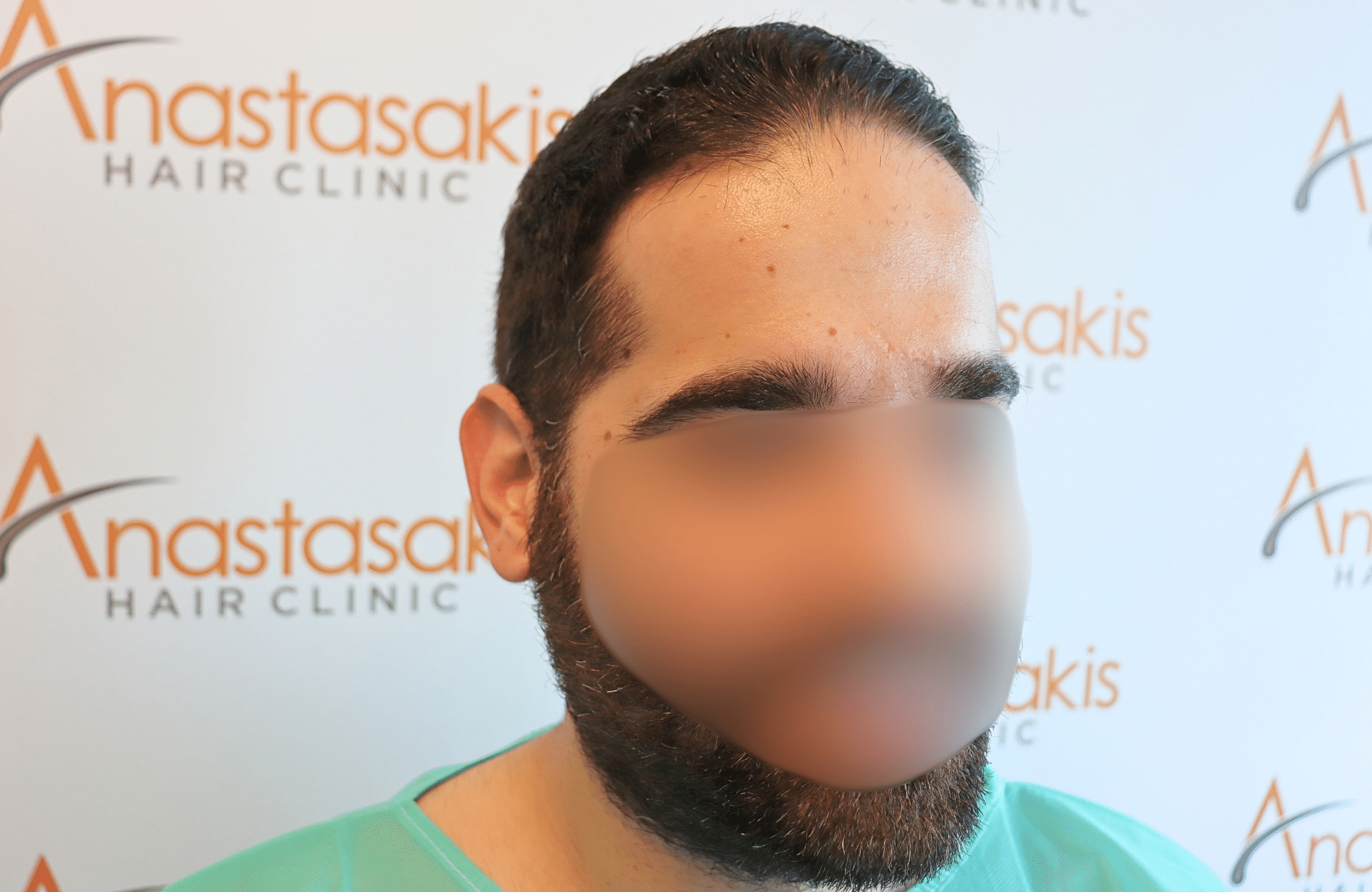 Hair Transplant Result 2300 fus frontal thick (3)