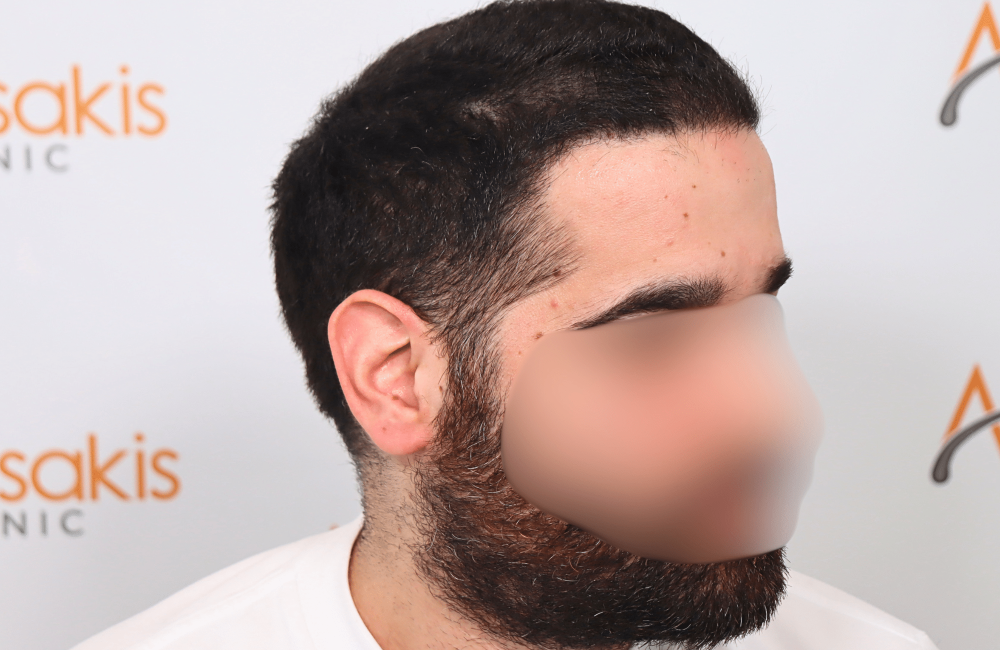 Hair Transplant Result 2300 fus frontal thick (4)