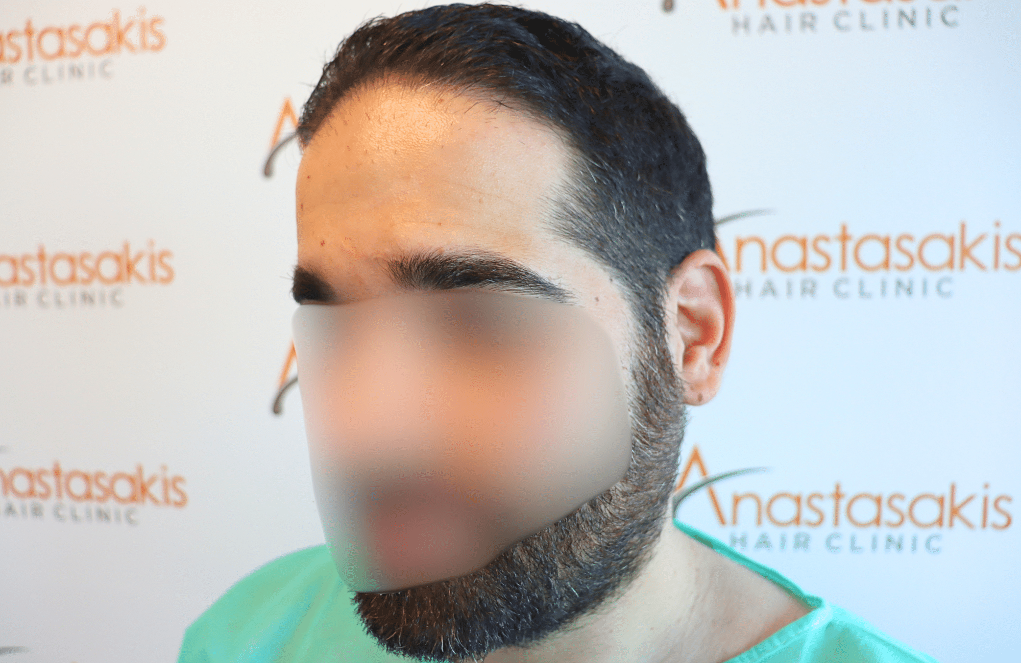 Hair Transplant Result 2300 fus frontal thick (12)