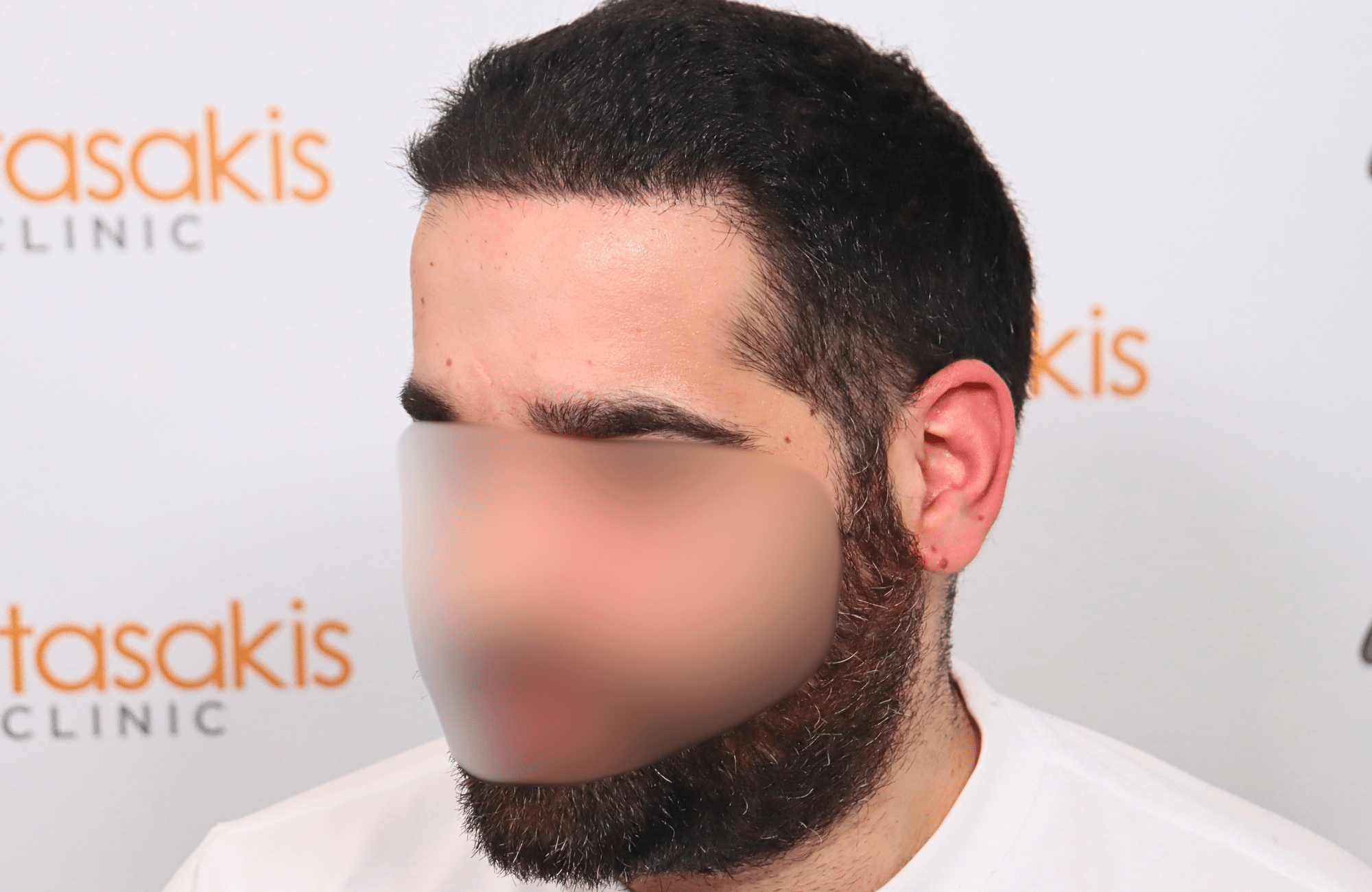 Hair Transplant Result 2300 fus frontal thick (6)
