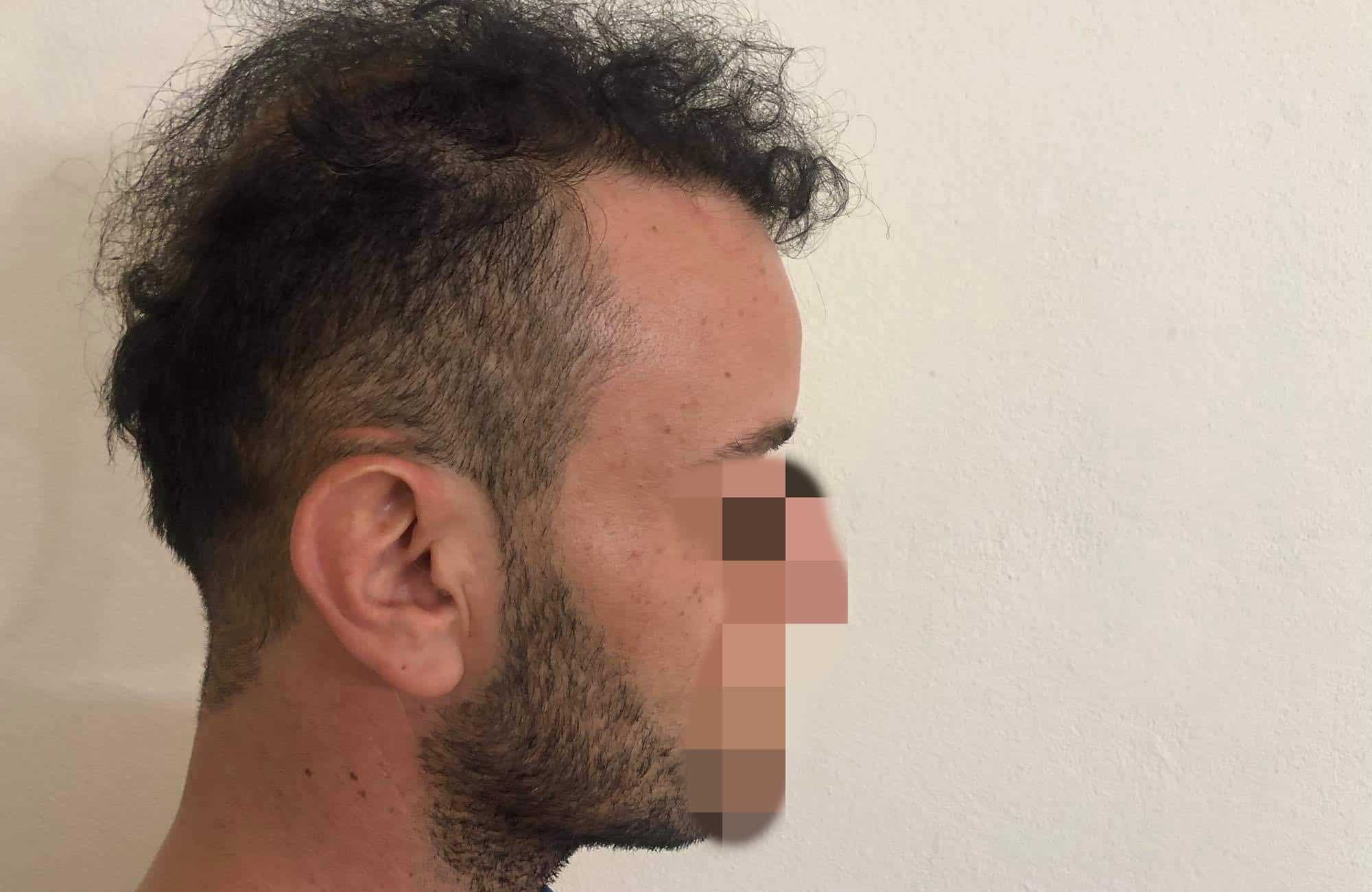 μεταμοσχευση μαλλιων πριν και μετα