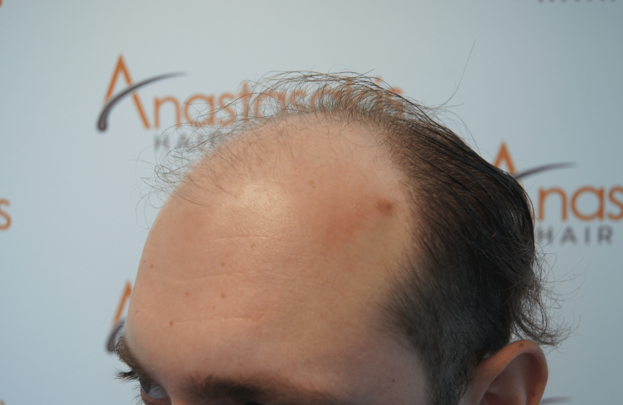 hair transplant with 3500 fus fue before - side1