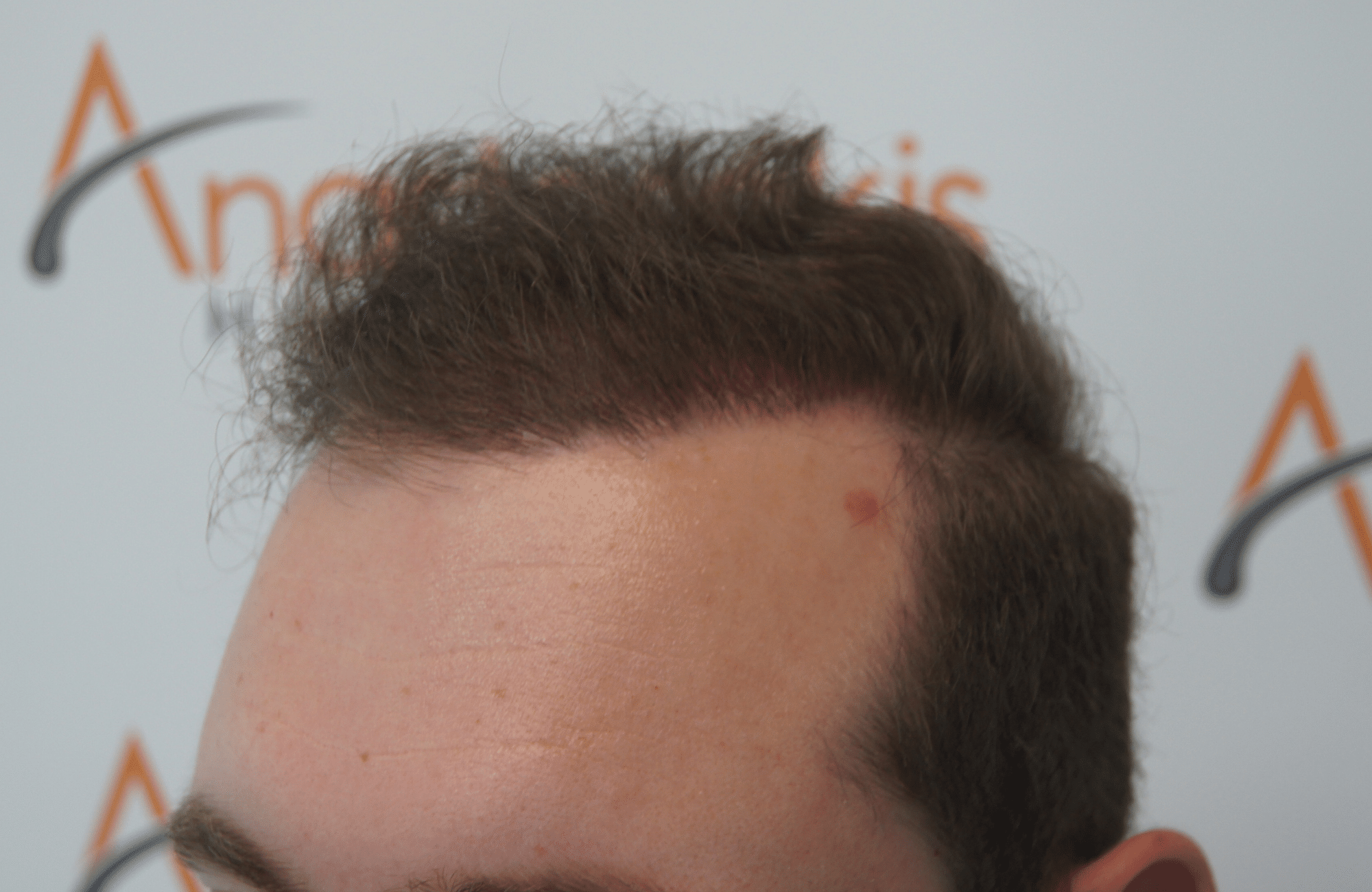 hair transplant with 3500 fus fue after - side1