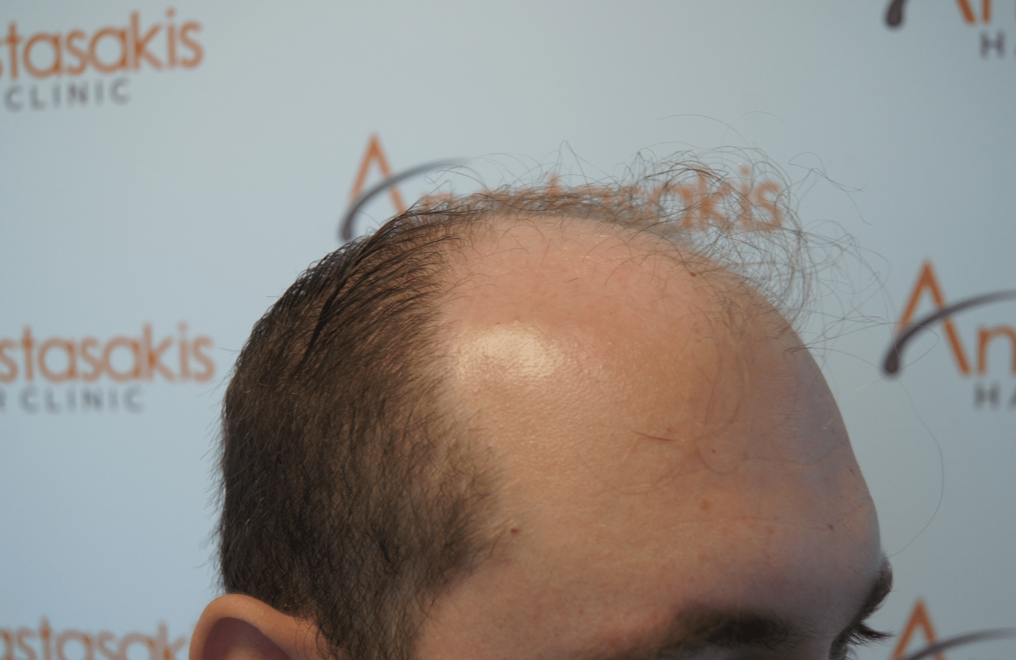 hair transplant with 3500 fus fue before - side2
