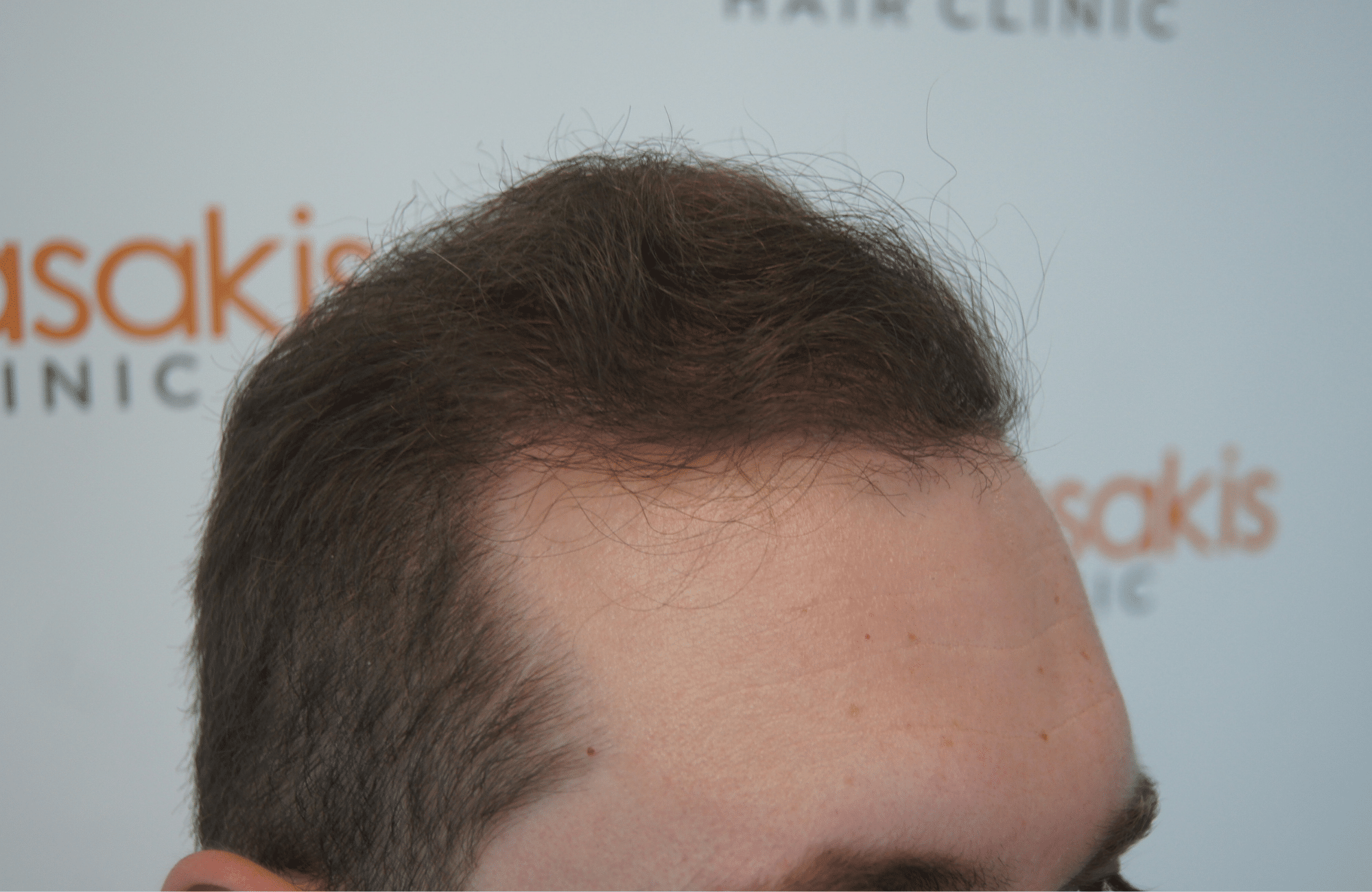 hair transplant with 3500 fus fue after - side2