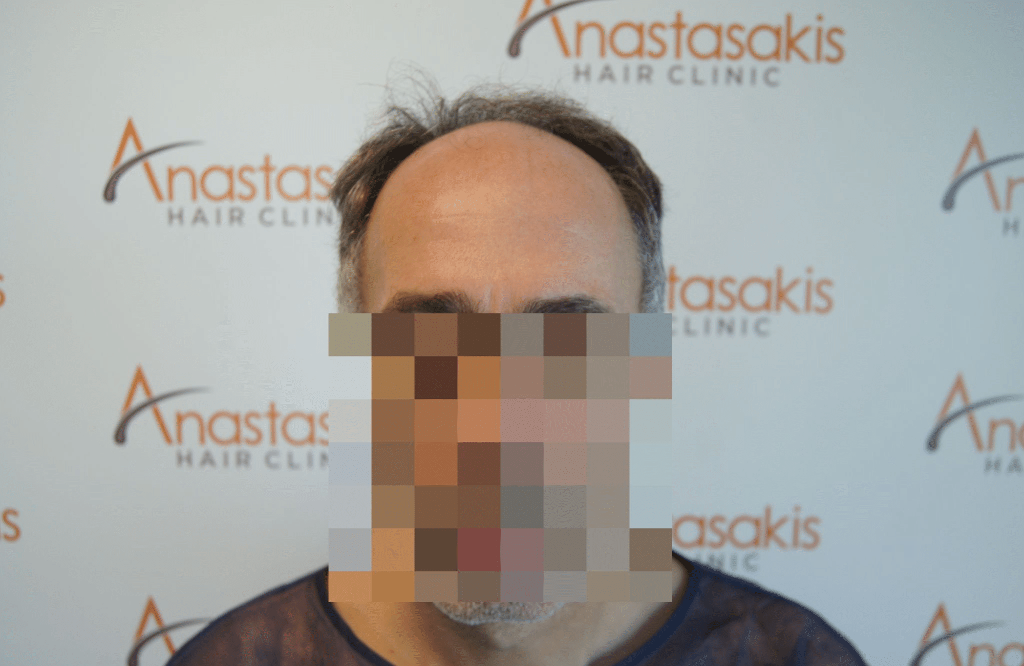 peristatiko prin ti metamosxefsi mallion me 3500 fus fullface