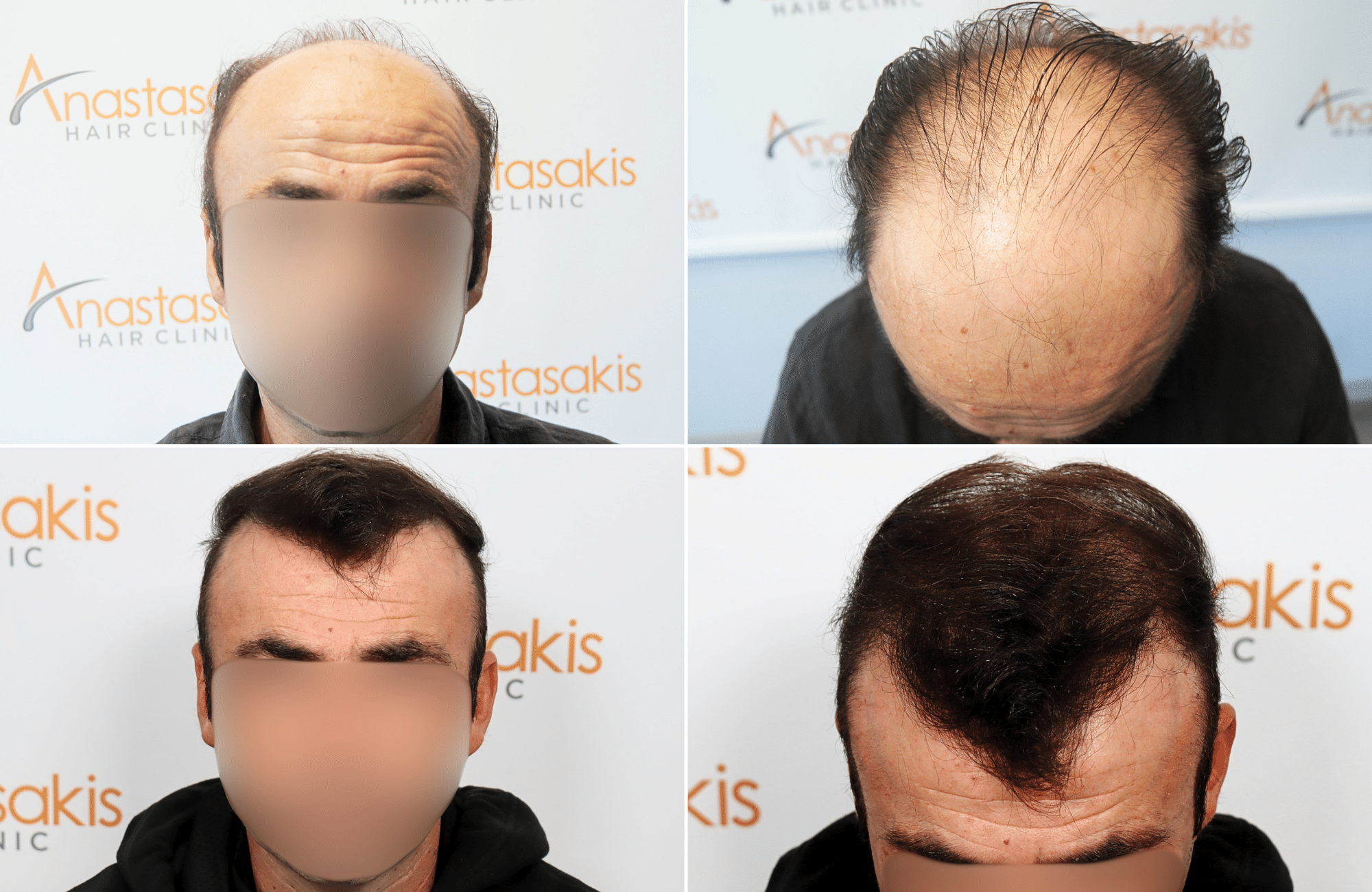 https://www.anastasakishairclinic.gr/portfolio/apotelesma-metamosxefsis-mallion-anastasakis-hair-clinic-48/
