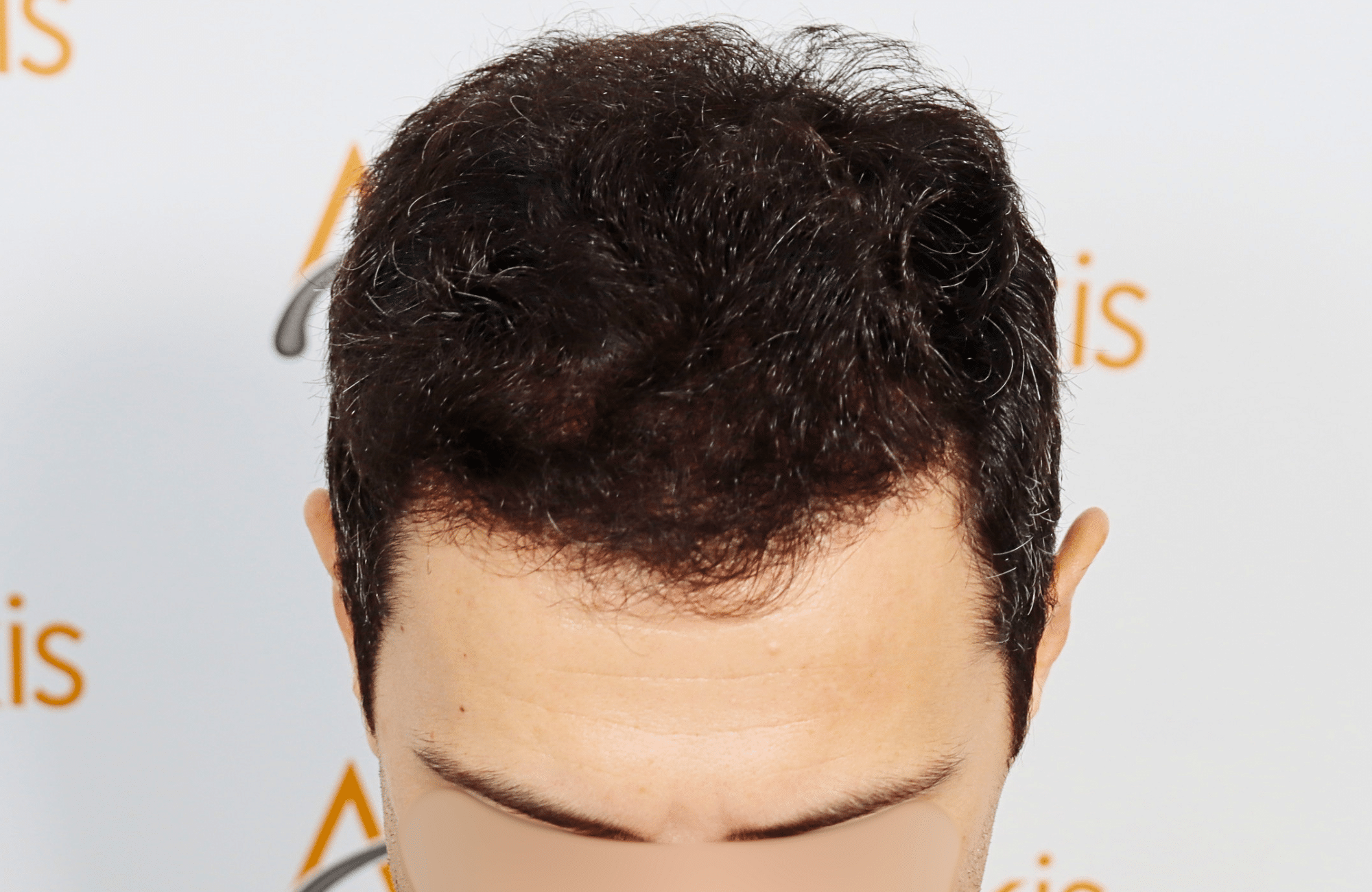 hair transplant 2200 fus stage 3 thick