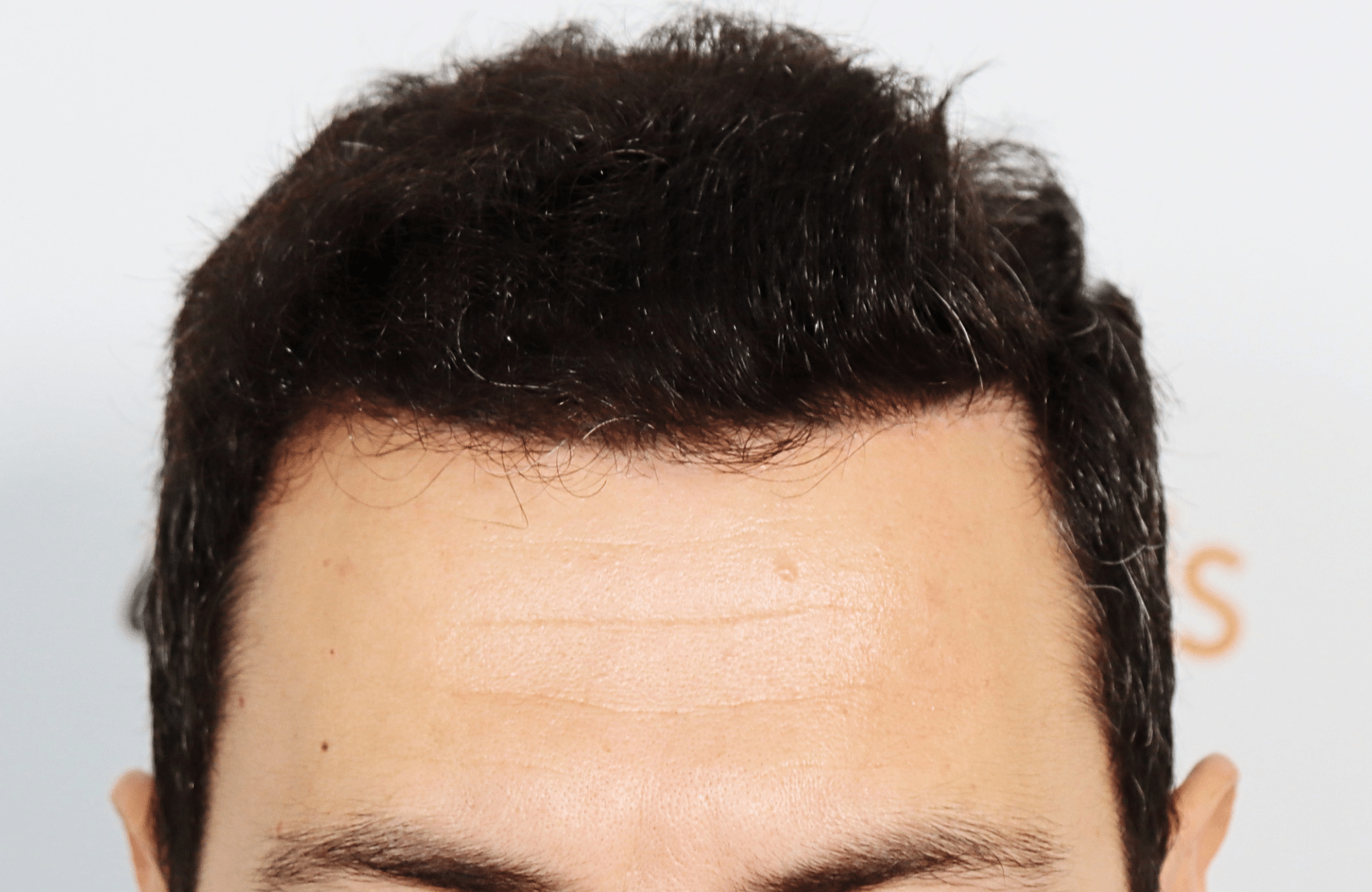 hair transplant 2200 fus stage 3 thick