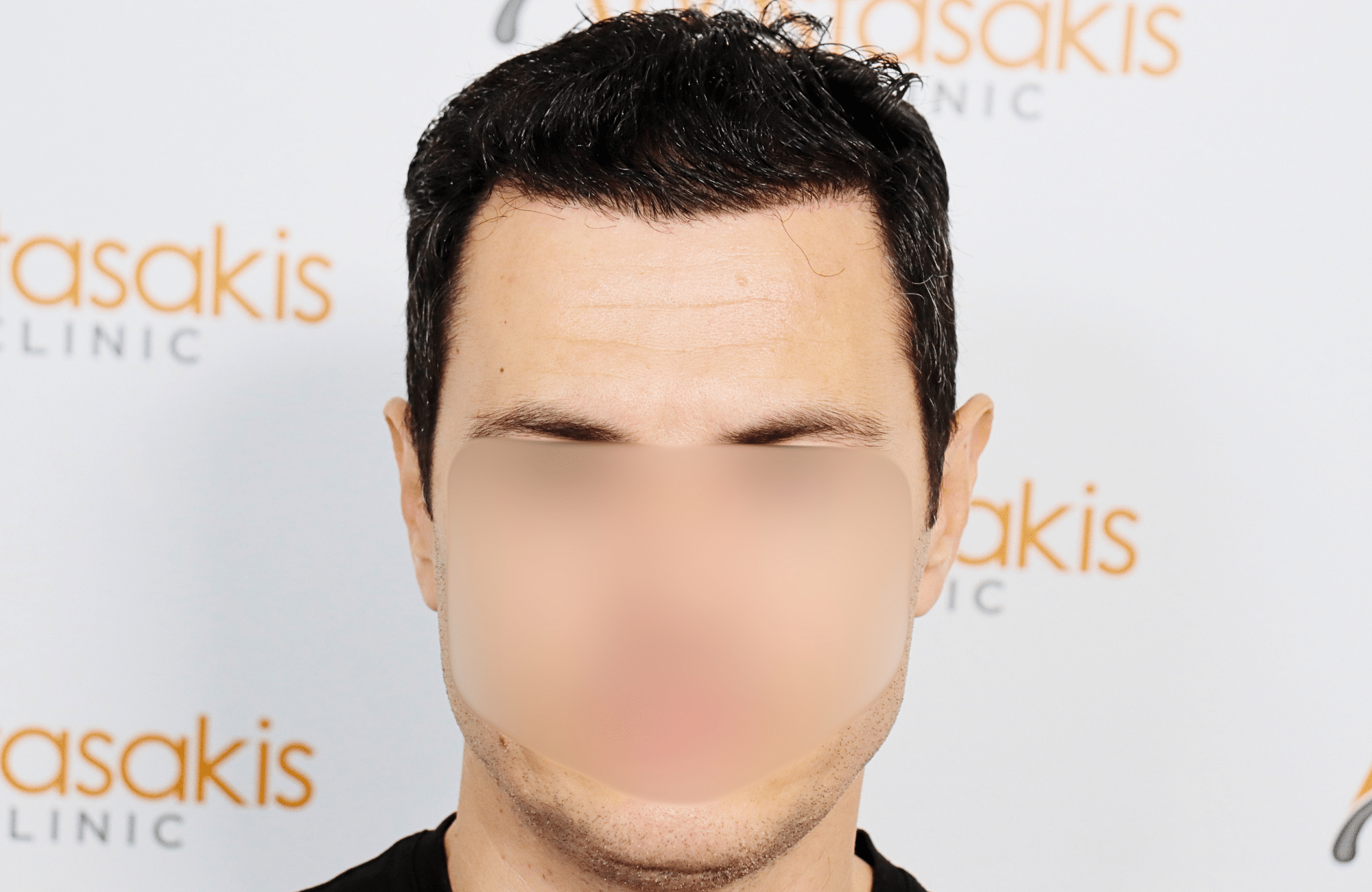 hair transplant 2200 fus stage 3 thick