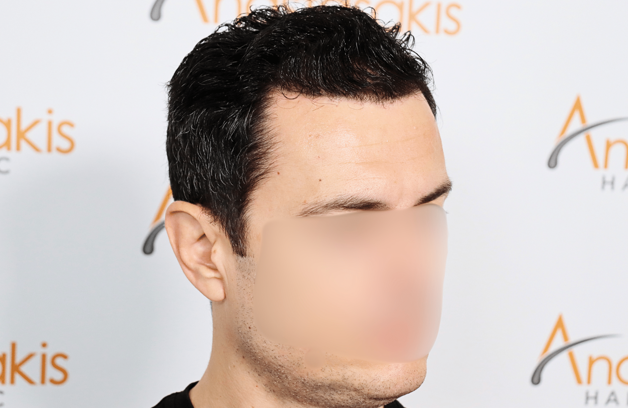 hair transplant 2200 fus stage 3 thick