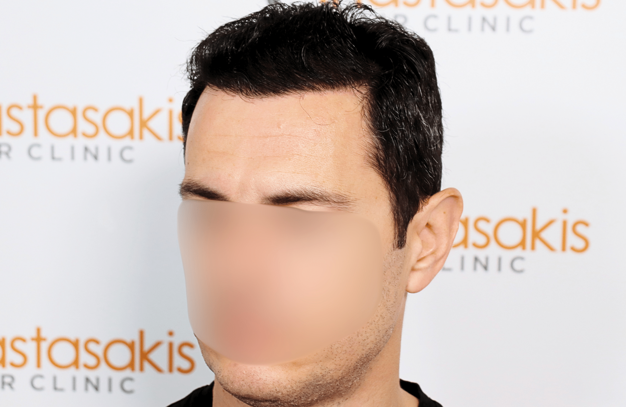 hair transplant 2200 fus stage 3 thick